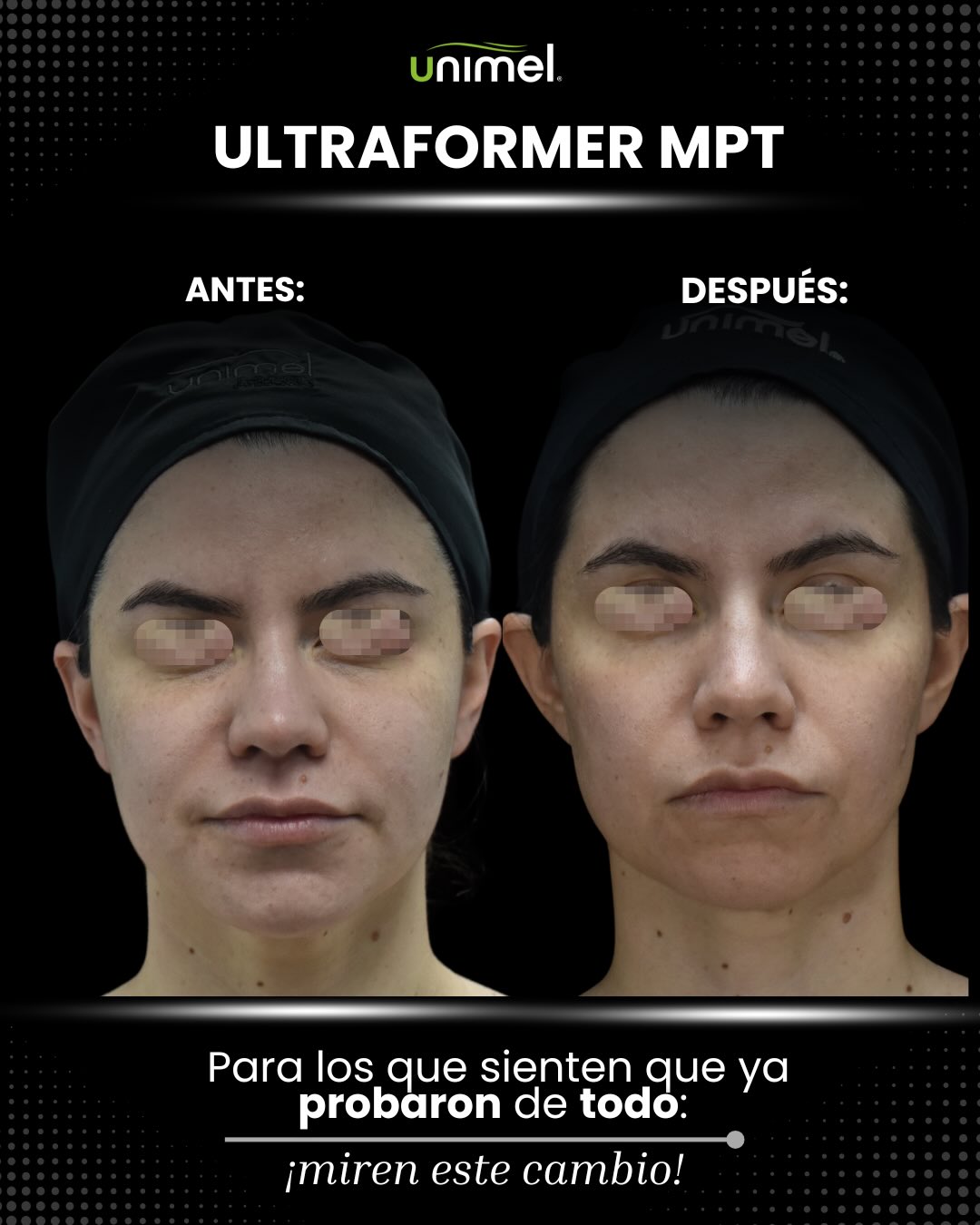 Mirarse al espejo y sentirse cómoda con lo que ves es un antes y un después.
Con Ultraformer mpt logramos reducir la papada de nuestra paciente, enmarcar su línea mandibular y regalarle un efecto lifting súper natural y sin cirugías.
Desliza ➡️ para ver cómo estimulamos su propio colágeno para devolverle esa firmeza y definición que tanto buscaba.
¿Te gustaría lograr este cambio en Unimel?
#Ultraformermpt #Efectolifting #Papaoff #Unimel