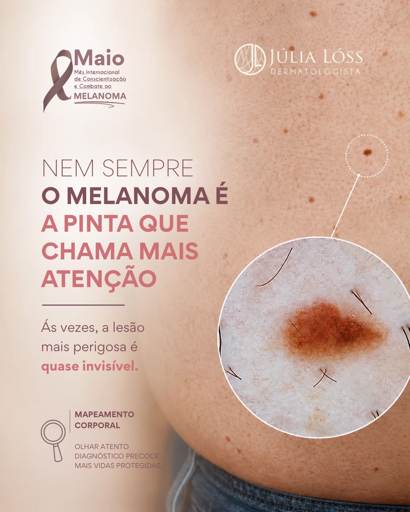 Nem todo melanoma é grande, escuro ou óbvio.
Muitos melanomas iniciais passam despercebidos pelo próprio paciente.
Por isso, avaliação especializada, dermatoscopia e acompanhamento dos nevos fazem diferença.
Dra. Júlia Lóss - Médica Dermatologista Oncológica
CRM 5201085638 RQE 34041
#maiomelanoma #melanoma #dermatoscopia #dermatologiaoncologica