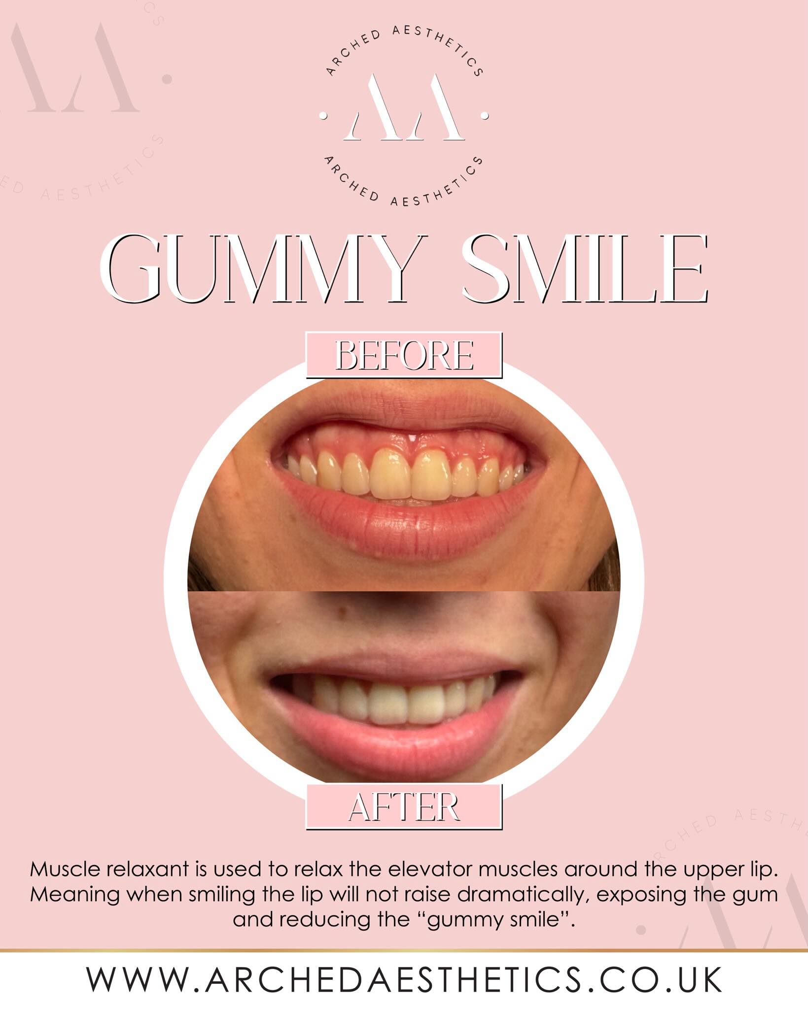 ⠀
Ever wondered how a gummy smile treatment works? 😊✨
A gummy smile treatment is a non-surgical option that uses tiny injections to relax the muscles responsible for lifting the upper lip too high when you smile. By softening the movement of these muscles, less gum tissue is exposed, creating a more balanced and harmonious smile.
The result is subtle and natural looking, meaning your smile still looks like you, just with less gum show and improved symmetry.
If you’ve always felt self conscious about showing too much gum when you smile, this simple treatment can make a noticeable difference without changing the shape of your lips. It’s a quick, effective way to enhance your natural features and boost your confidence.
__________________________
Get in touch 👇🏽
𝐃𝐌 𝐔𝐒 𝐅𝐎𝐑 𝐄𝐍𝐐𝐔𝐈𝐑𝐈𝐄𝐒
GIFT VOUCHERS AVAILABLE
SWIPE FOR CLINIC DATES
⭐️ 5 STAR GOOGLE REVIEWS
💻 www.archedaesthetics.co.uk
📱 𝗪𝐇𝐀𝐓𝐒𝐀𝐏𝐏 07517416782
📧 hello@archedaesthetics.co.uk
#lipfillerplymouth #dermalfillerplymouth #aestheticscallington #dermalfillercallington #aestheticsliskeard