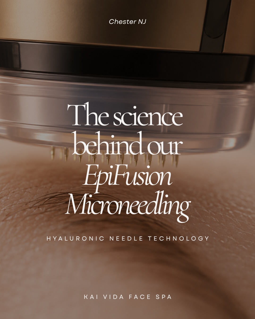 ✨ Love the idea of microneedling but not the downtime?
Meet our Epifusion Facial—a next-generation micro-infusion treatment that uses dissolvable hyaluronic acid micro-cones instead of traditional metal needles.Think of it as a gentler alternative to traditional microneedling—designed to create temporary micro-infusion pathways that enhance ingredient absorption while delivering powerful hydration support to the skin.
✔ Fine lines & loss of firmness
✔ Enlarged pores
✔ Uneven texture
✔ Dull, tired-looking skin
✔ Post-acne concerns
✔ No downtime
Finished with our signature EpiMask & Gold Foil Enhancement for the ultimate glow.
📍 Chester, NJ
✨ Kai Vida Face Spa
#KaiVidaFaceSpa #ilovechesternj #medspanj #Microneedling #mendhamnj