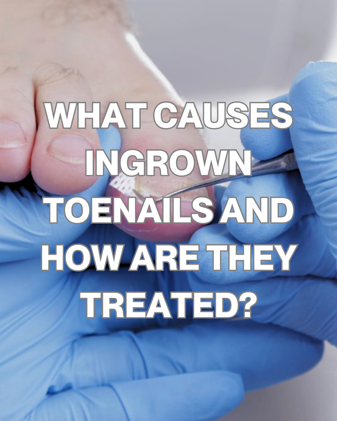 Ingrown toenails occur when the edge of the nail grows into the surrounding skin, causing pain, redness, and sometimes infection.
They are often caused by cutting nails too short or rounding the corners, wearing tight or narrow shoes, or repeated pressure from activities like running. In some cases, nail shape or genetics can also play a role.
Treatment depends on severity and may include gently lifting the nail edge, reducing pressure, treating any infection, or in recurring cases, a minor in-office procedure to remove part of the nail so it grows back correctly. Early treatment helps prevent worsening pain and infection.
Book an appointment online: www.surfcoastpodiatry.com