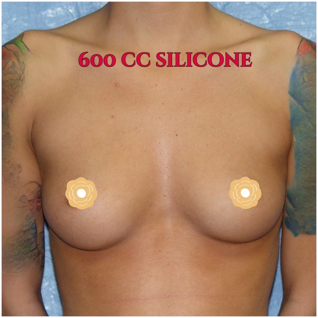 600 cc gel implants have never looked so round and perky! Call now for our Super Summer Specials! Saline Breast Aug -->$3995 Silicone Breast Aug --> $6495 Tummy Tuck starts at --> $7995. Call (714) 500-0050 #drluudoan #breastaug #salineimplants #siliconegelimplants #tummytuck #abdominoplasty
