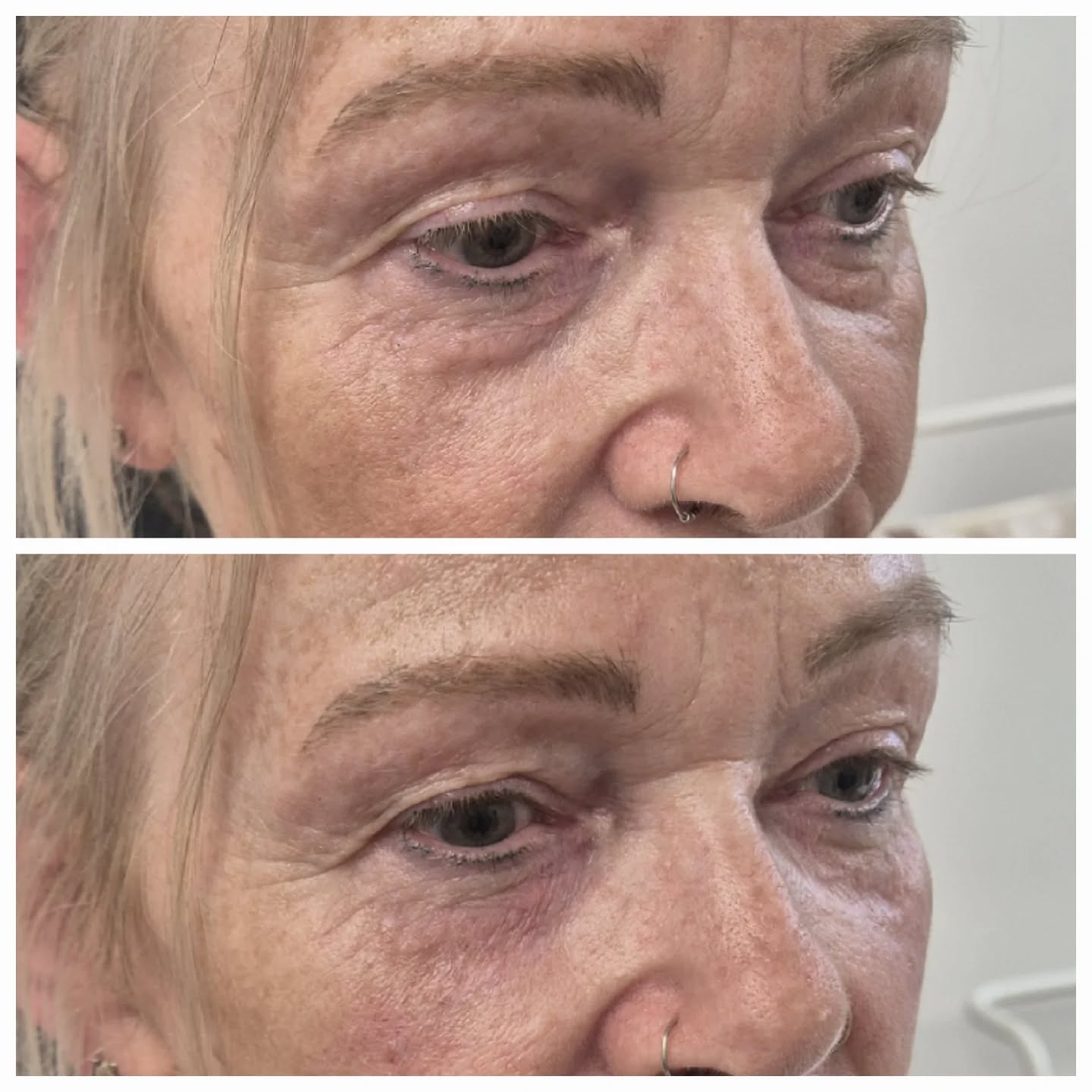 Tear trough filler can be one of the most challenging treatments in aesthetic medicine, particularly in mature patients where under-eye fat pads, skin laxity, and age-related changes are present.
Many practitioners will say these patients are not suitable for treatment, but with careful assessment, realistic expectations, and advanced technique, improvement is often possible.
In this lovely patient, the aim was not perfection. The aim was softening the transition between the lower eyelid and cheek, reducing the appearance of tiredness, and creating a fresher, more rested look. While tear trough filler cannot remove under-eye fat pads, it can help camouflage the surrounding hollowing and improve overall facial harmony.
The key to successful tear trough treatment is understanding anatomy, selecting the right patient, and knowing when subtle improvement is the best outcome. Sometimes a 30-50% improvement can make a significant difference to how a patient looks and feels.
Natural results. Realistic expectations. Thoughtful treatment planning.