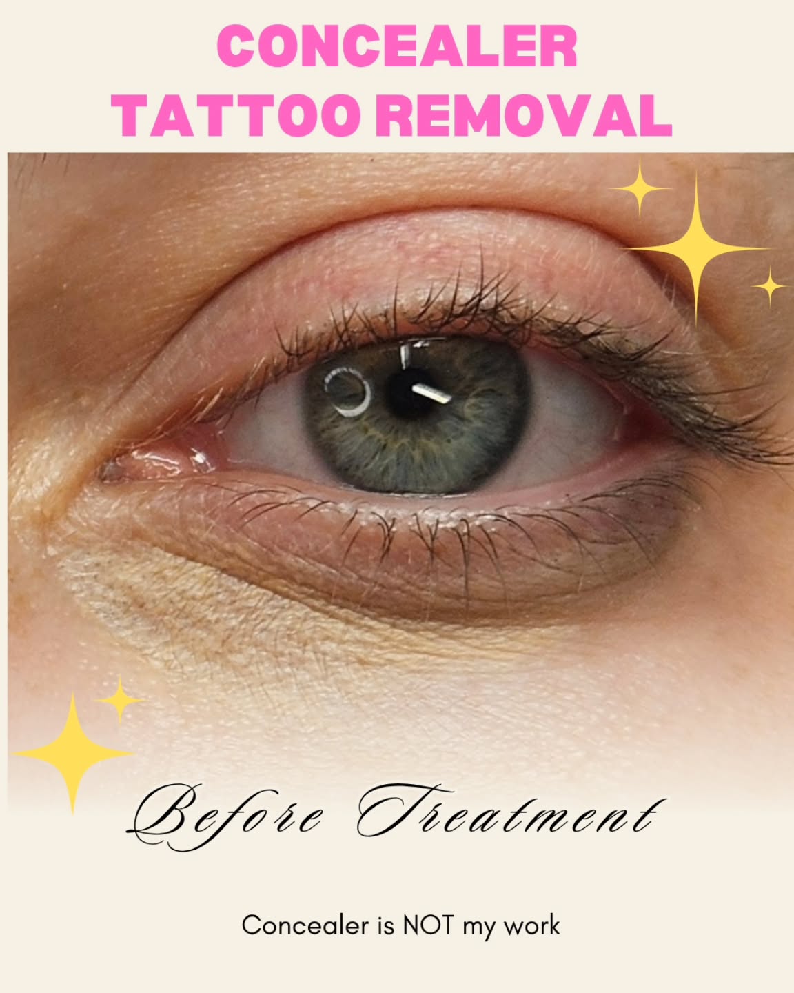 ๐ Concealer Tattoo Removal. Most people know about brow tattoos, but many are surprised to learn that concealer can be tattooed under the eyes as well.
This client came to me seeking removal of an under-eye concealer tattoo that did not match her skin tone and the yellow tone had become more noticeable over time.
We're just beginning the removal process, and I'll be documenting her progress along the way.
โจ Before treatment photo shown.
โจ Original cosmetic tattoo was performed elsewhere.
If you have unwanted permanent makeup and aren't sure what your options are, text me. I can help ๐
#ConcealerTattooRemoval #PMURemoval #PermanentMakeupCorrection #SalineTattooRemoval #PermanentMakeupRemoval