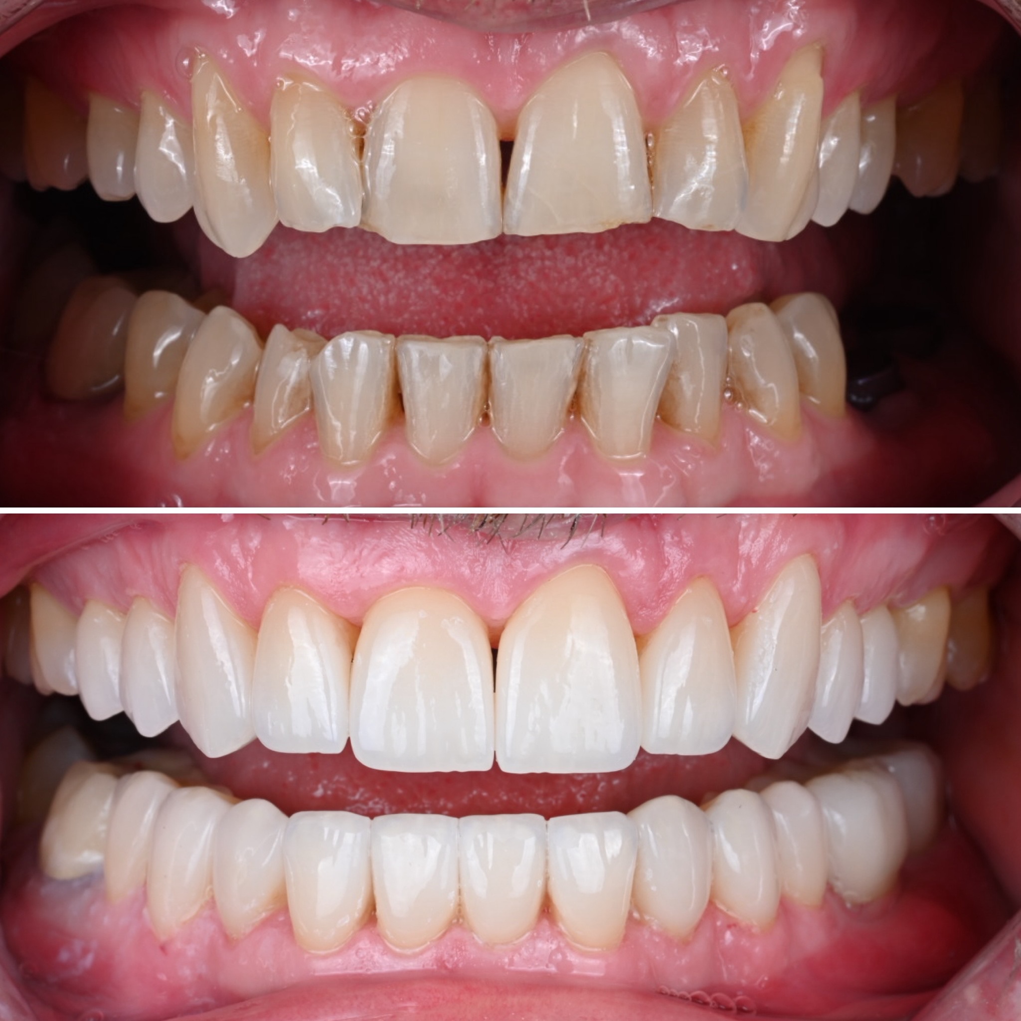 In this complex case, we restored lost vertical dimension with high-end ceramic onlays, rebalanced a constricted bite pattern, and rejuvenated worn, aged-looking teeth with individually crafted porcelain veneers.
The treatment also included periodontal therapy to create a healthier foundation, as well as two dental implants to replace chronically infected teeth and help eliminate infection within the jawbone.
The goal was not only a more youthful and harmonious smile, but also a healthier, more balanced, functional, and stable bite.
High-end dentistry is where aesthetics, biology, health, and function come together.
#BiteLift #CeramicOnlays #PorcelainVeneers #DentalImplants #PeriodontalTreatment GumHealth FullMouthRehabilitation SmileRejuvenation CosmeticDentistry AestheticDentistry Occlusion BiteRehabilitation HighEndDentistry SmileMakeover DentalExcellence AbuDhabiDentist DubaiDentist UAEDentist DrMoritz