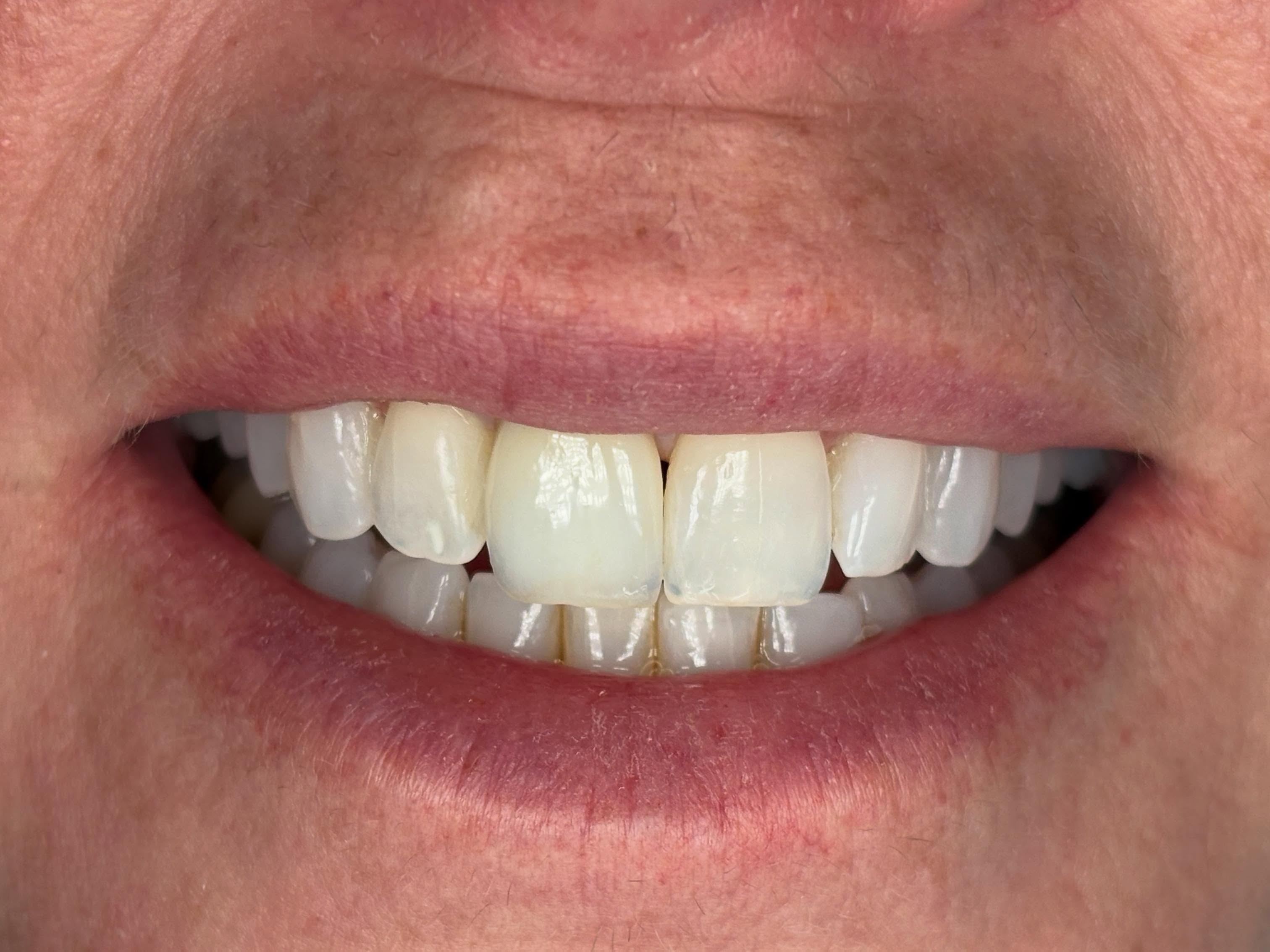 Teamwork between Clinician and Master Ceramist… to restore the confidence of a natural smile, as ever.
Another e.max buccal cutback with custom shade and mimetic characterization by our experts at Precision Esthetics Dental Laboratory.
#confidentwomen #confidentsmile #takeovertheworld