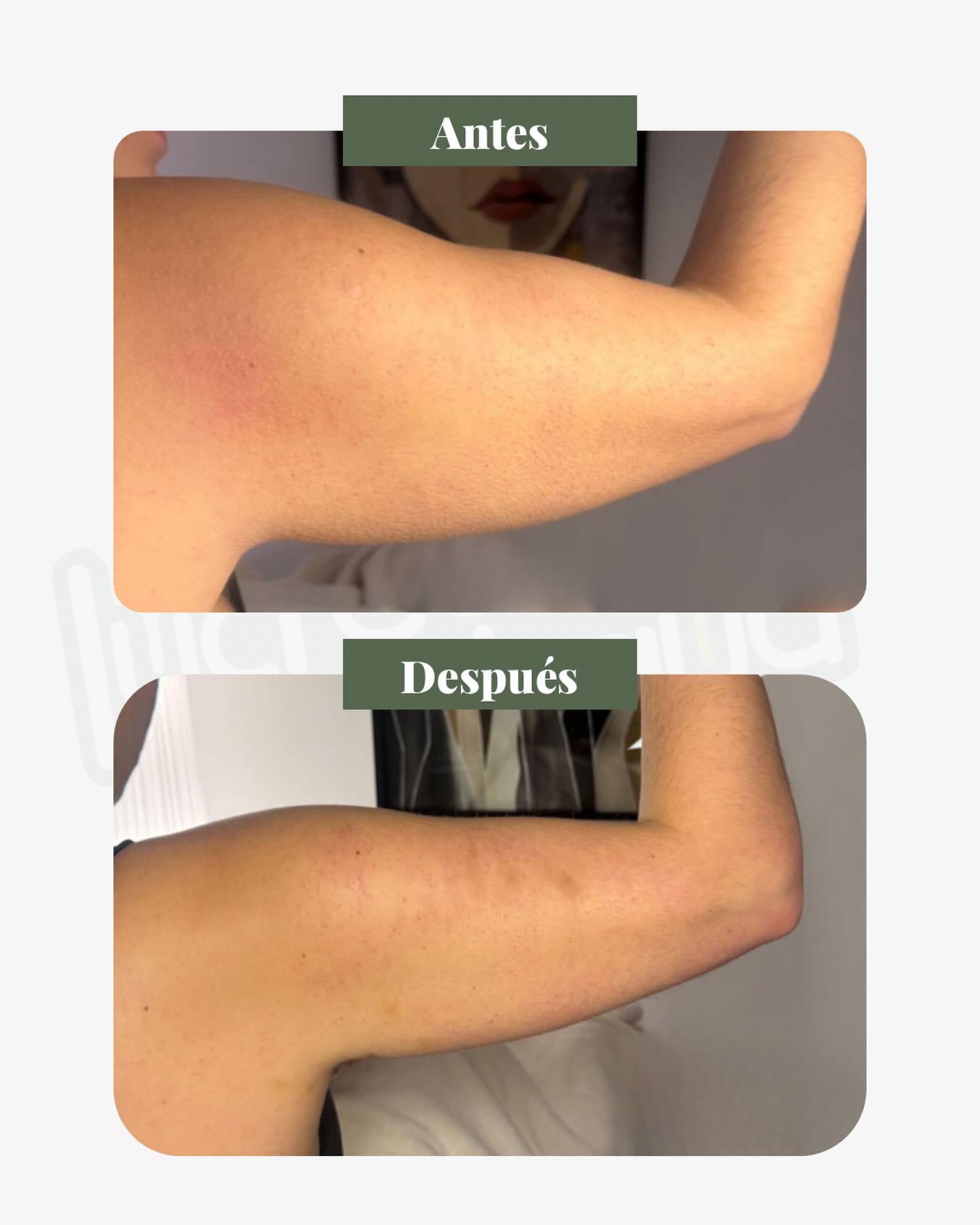 ✨ Resultado progresivo con HIFU 22D ✨
Mira este antes y después en zona de brazos 🙌🏻
Con tecnología HIFU 22D trabajamos la flacidez y estimulamos la producción de colágeno desde capas profundas de la piel, logrando una apariencia más firme, lisa y uniforme 💥
Los resultados son progresivos y continúan mejorando con las semanas 🤍
📍Vitacura 9910, Santiago
🚗 Estacionamiento Amplio y privado
#hifu #hifu22d #antesydespues #flacidez #brazos
