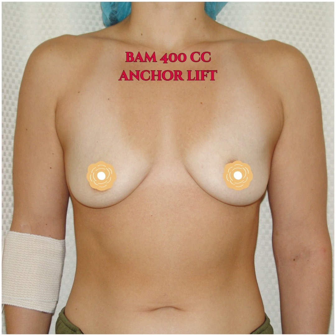 BREAST AUGMENTATION with ANCHOR BREAST LIFT is for women with flat, saggy breasts. Saggy breasts are caused by aging, multiple pregnancies, and massive weight changes. Breast implants will enhance breast volume. Anchor breast lift will remove loose, saggy skin to make breasts tighter and perkier. Call us now at 714-500-0050 for a consultation. #drluudoan #bellabeachbod #breastaugmentation #anchorbreastlift #mastopexy #siliconegelimplant #salineimplants #OCplasticsurgery #OCcosmeticsurgery #LAplasticsurgery