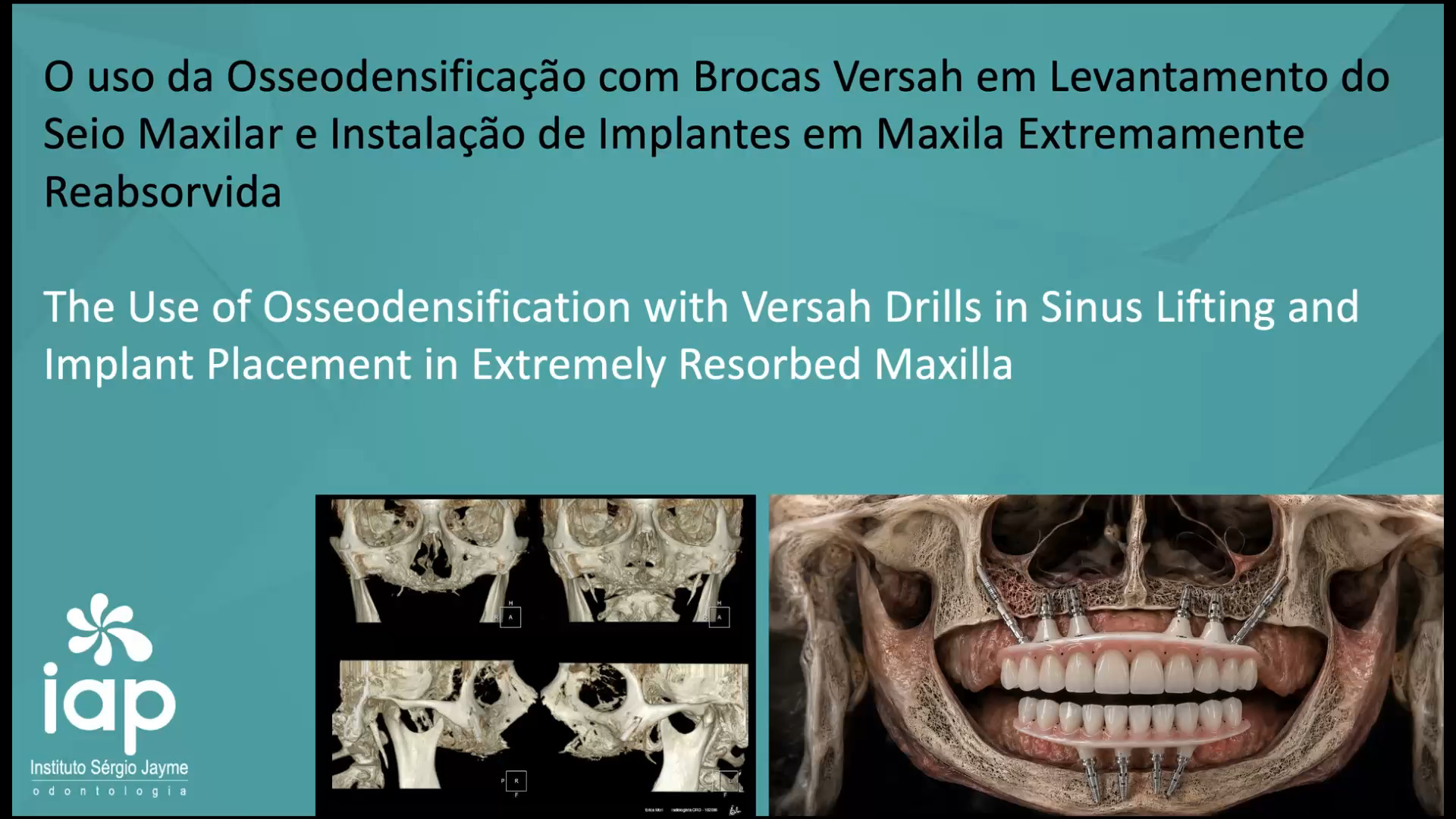 O uso da Osseodensificação com Brocas Versah em Levantamento do Seio Maxilar e Instalação de Implantes em Maxila Extremamente Reabsorvida
The Use of Osseodensification with Versah Drills in Sinus Lifting and Implant Placement in Extremely Resorbed Maxilla
Instalação de 2 implantes convencionais de 3,5 X 17 no osso zigomático bilateral (Técnica Facco) e 2 pilares Z
Nesse caso especifico, foi usada a técnica de osseodensificação com as brocas Versah a 1500 rpm no sentido anti-horário, dessa forma, melhoramos a qualidade óssea e estabilidade dos implantes.
O uso de brocas Versah (Densah) para levantamento do seio maxilar eleva a membrana com segurança, preserva o osso autógeno e dispensa grandes enxertos na maioria dos casos.
A técnica utiliza um protocolo específico de rotação e irrigação para condensar o biomaterial adequadamente.
Altura óssea residual mínima de 4-5 mm. Largura alveolar mínima necessária = 5 mm
• MEÇA A ALTURA DO OSSO ATÉ O ASSOALHO DO SEIO
• EVITE A UTILIZAÇÃO DE UMA BROCA PILOTO
• COM A BROCA DENSAH® (2,0), É POSSÍVEL AVANÇAR ATÉ
A ALTURA DO ASSOALHO DO SEIO
• INTRODUZA A BROCA DENSAH® (3,0) ATÉ 3 MM PARA
ALÉM DA ALTURA INICIAL DO ASSOALHO DO SEIO, ROMPENDO
CUIDADOSAMENTE A CORTICAL
• UTILIZE A ÚLTIMA BROCA DENSAH® EM BAIXA VELOCIDADE PARA IMPULSIONAR DELICADAMENTE O ALOENXERTO BEM HIDRATADO
• NÃO AVANCE MAIS DO QUE 3MM ALÉM DA ALTURA INICIAL DO ASSOALHO DO SEIO.
Os implantes foram instalados na posição tridimensional protética ideal, dessa forma, podemos confeccionar a prótese parafusada, de fácil manutenção, garantindo estética e função.
Dr. Sérgio Jayme
Av. Paulista, 91 Cj 402 Tel (11)5572-1283 / Cel e WhatsApp (11)94888-2000 CEP:01311-000 São Paulo-SP
Av. Rubem Berta, 1461 Tel (11)2276-2217 / Cel e WhatsApp (11)98383-3941 CEP: 04074-010 São Paulo-SP
#implante #periodontia #curso #rog #enxertoosseo #enxerto #iap #protesedental #protesedentaria #sergiojayme #sergiojaime #cienciaemvideo #implantesdentarios #implantes #implant #implants #implantdentistry #implantology #implantodontia #geistilich #nobelbiocare #iapcursos
#osseodensificacao #brocasversah #tecnicafacco #pilarz #seiomaxilar