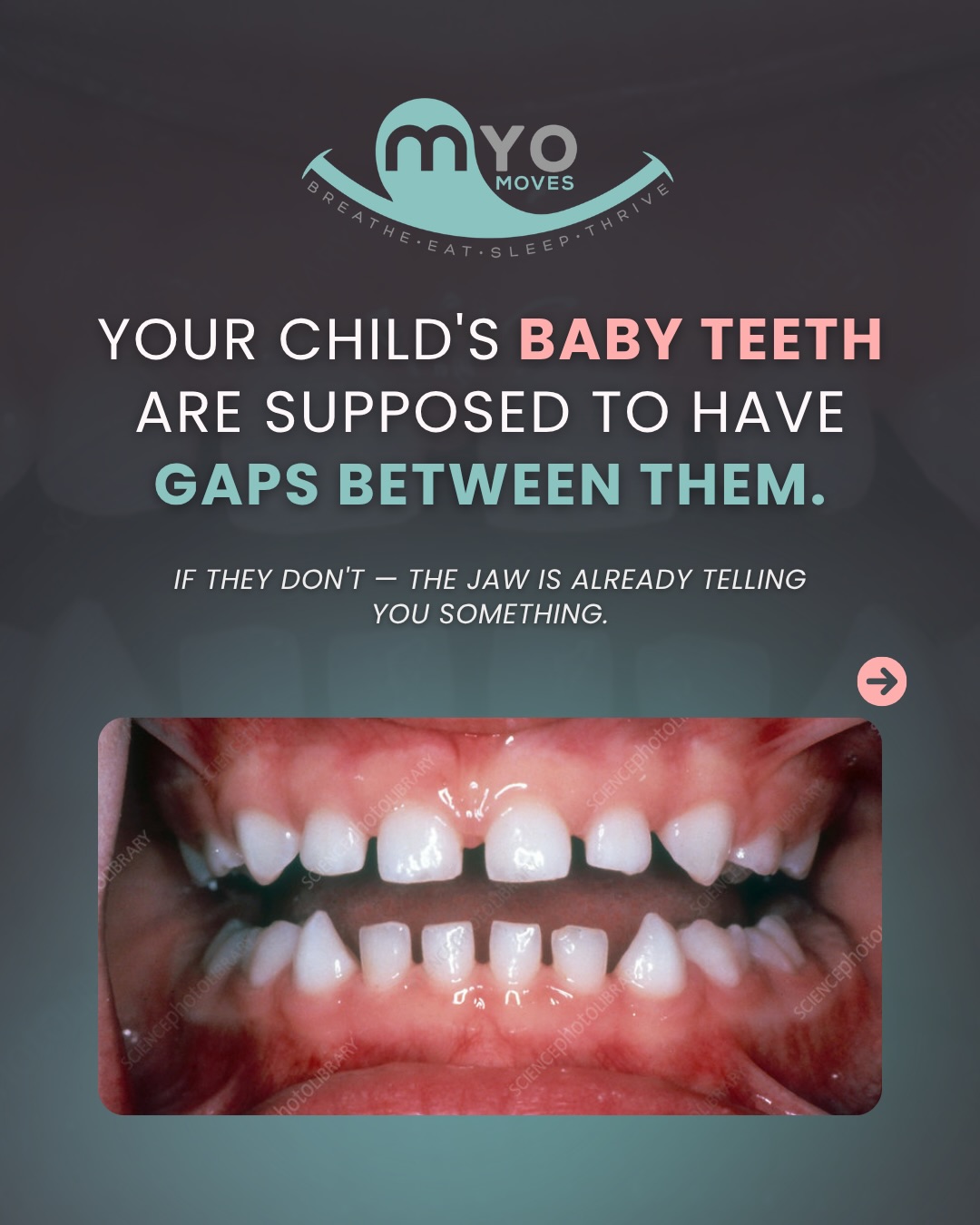 Baby teeth should have gaps! Those tiny spaces tell a big story: your child’s jaw and airway are growing the way they’re supposed to.
Tight, touching baby teeth? That can signal a narrow jaw and limited space for adult teeth, which can lead to crowding, misalignment, and even airway issues.
The tongue is the secret behind healthy jaw growth. When it rests on the roof of the mouth, it gently guides the palate to expand, creating room for teeth and supporting nasal breathing.
Without proper tongue posture:
👅 The jaw may stay narrow
💨 Mouth breathing will continue
🦷 Teeth may crowd and overlap
That’s why early myofunctional intervention can be so powerful! We retrain tongue posture, breathing patterns, and oral habits, giving your child the foundation for a healthy smile and airway!
💬 Comment “GUIDANCE” if you want to schedule a guidance call to discuss your child’s breathing habits.
#myofunctionaltherapy #babyteeth #myo #airwayhealth #tongueposture