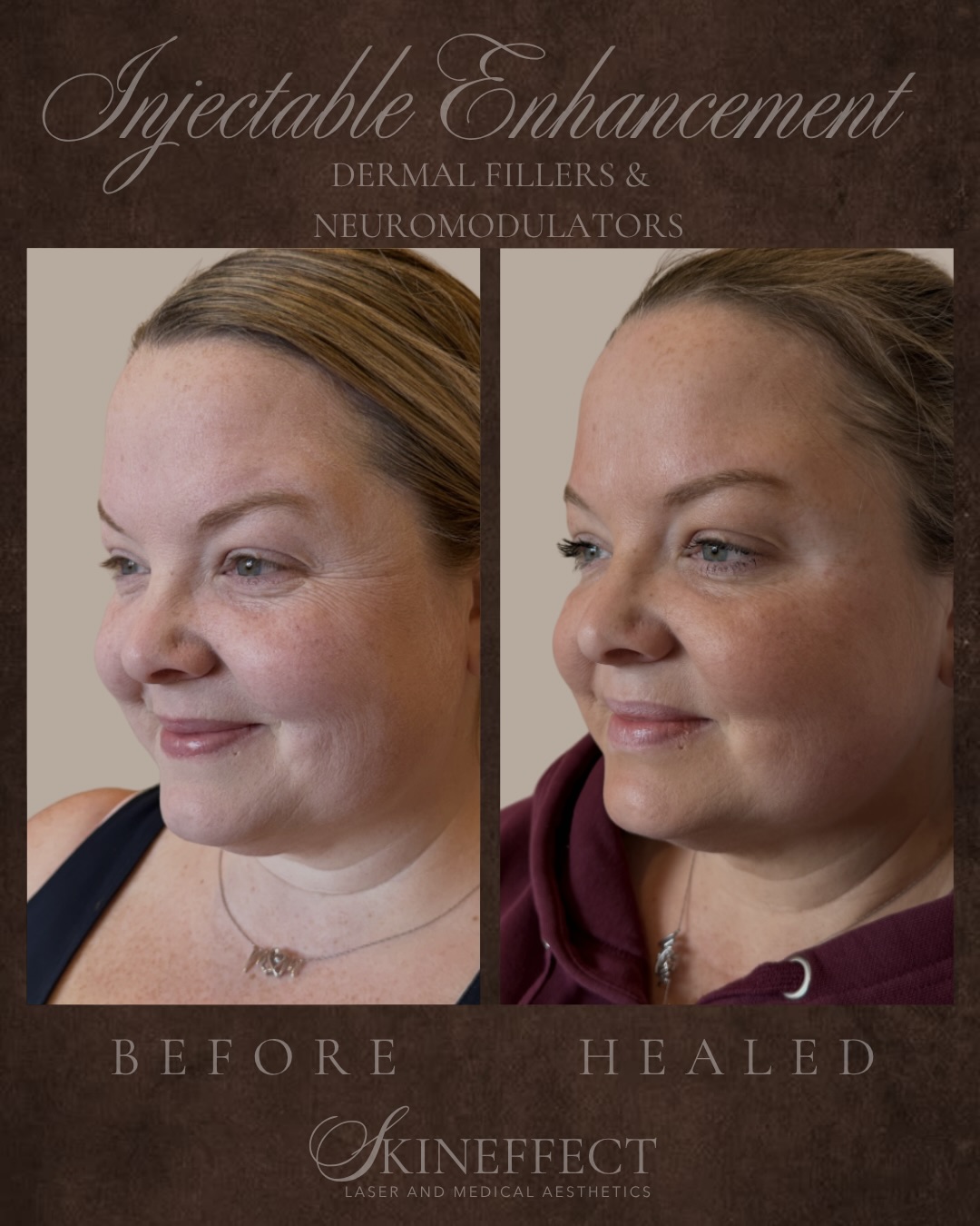 She didn’t change her face. She just turned the volume up. ✨
Dermal Fillers + Neuromodulators are your skin’s best friend when wanting a subtle yet powerful transformation! 💉🫧
Save for inspo 💌
📍SkinEffect Fort Saskatchewan & Sherwood Park.
→ Go to link in bio and let’s talk about your goals! 💋
#medicalaesthetics #yegmedispa #luxurymedispa #luxurylifestyle #injectable
•
•
•
{Edmonton Medi Spa • Sherwood Park Medi Spa • Fort Saskatchewan Medi Spa • yeg Medi Spa • yeg • Medical Aesthetics • Medical Aesthetician • Nurse Injector • Chemical Peel • HydraFacial • IPL • Microneedling • PRP • Vampire Facial • Forma • Fillers • Lip Filler • Cheek Filler • Chin Filler • Botox • Dysport • Nucieva • Spray tan • Sherwood park spray tan • Edmonton spray tan • spray tan Artist • NUDA spray tan}