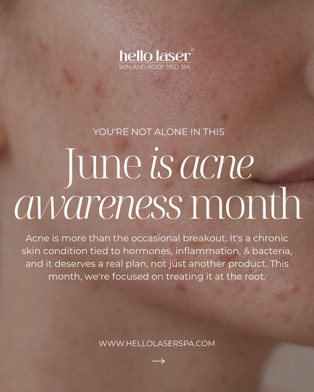 June is Acne Awareness Month, and we’re saying it loud: if you’re dealing with breakouts, you are NOT alone. 🧡
Here’s the truth nobody tells you… acne isn’t just “bad skin” or something you’ll grow out of. It’s a chronic condition tied to hormones, inflammation, and bacteria, and it deserves a real plan, not just another product you panic-buy at 11pm. 🛒❌
Swipe through to find YOUR breakout 👉
Hormonal? Cystic? Comedonal? Inflammatory? Or maybe it’s the marks left behind long after the breakout cleared. Whatever you’re seeing in the mirror, there’s a reason behind it, and a way to actually treat it.
Here’s how we get you clear 👇
✨ Face Reality Acne Program → targets the root cause, not just the surface
✨ Chemical Peels → clear congestion + fade post-acne marks
✨ Laser Facial Rejuvenation → calms inflammation + kills acne-causing bacteria
✨ Scar Revision + SkinPen Microneedling → smooth texture & soften old scarring
This month, let’s stop covering it up and start treating it at the root. Your clearest skin isn’t a fantasy, it’s a plan. 🤍
📞 Book your acne consultation: 480-905-3080
📍 Scottsdale · Biltmore · Phoenix
🔗 www.hellolaserspa.com
#acneawarenessmonth #hellolaser #acnetreatment #facerealityacne clearskinjourney scottsdaleesthetician phoenixmedspa acnesafe skinpenmicroneedling chemicalpeel