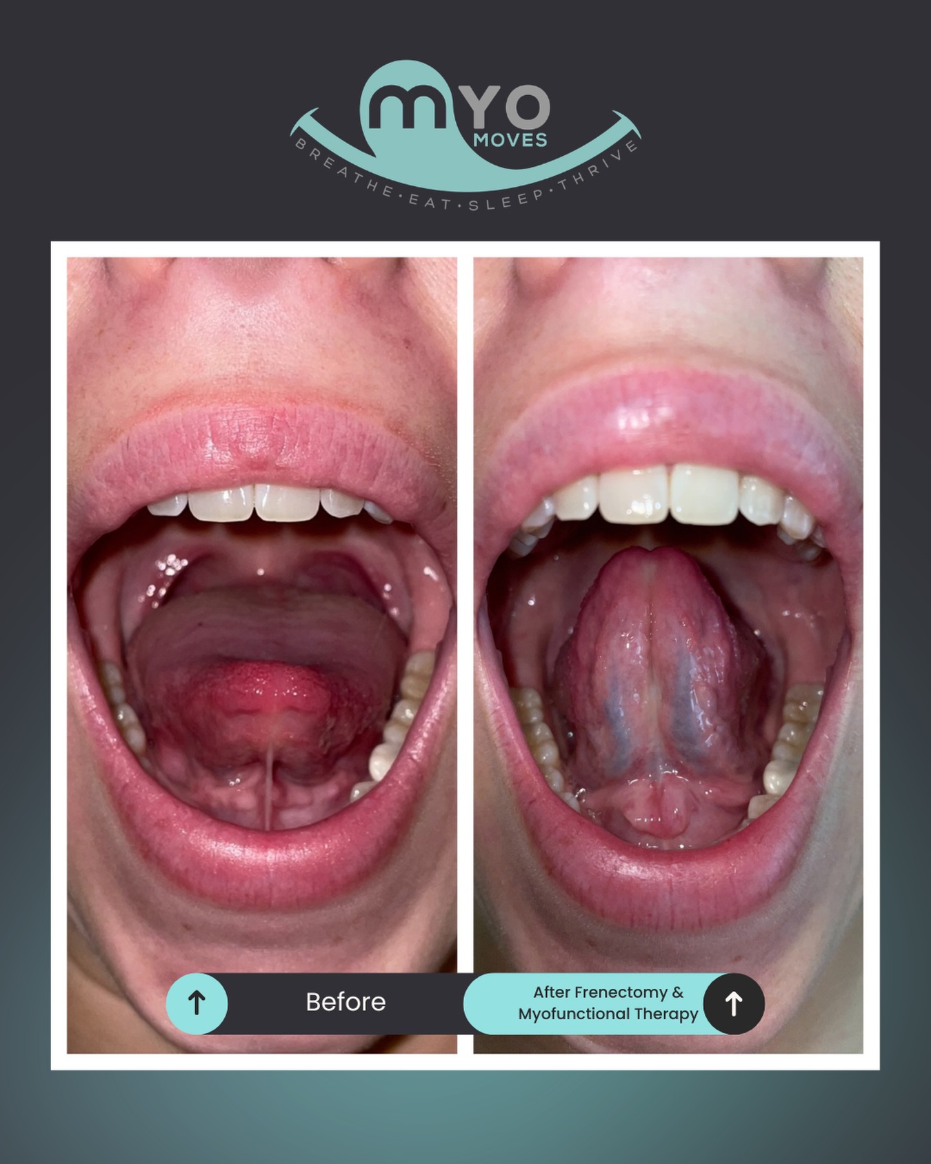 The tongue isn’t just free, it’s functional. 👅✨
This before-and-after shows what can happen when a tongue tie release is paired with proper myofunctional therapy.
➡️ Before: limited tongue mobility and restricted range of motion.
➡️ After: improved elevation, strength, and function following frenectomy + therapy.
A successful tongue tie release isn’t just about the procedure itself. The real magic happens when we retrain the muscles and build new oral habits so the tongue can do its job properly.
Why does that matter? Because tongue function impacts:
✔️ Breathing
✔️ Sleep quality
✔️ Swallowing
✔️ Speech
✔️ Facial growth and development
The goal isn’t simply more movement—it’s better function for life.
Have questions about tongue ties or wondering if you or your child could benefit from an evaluation? Comment GUIDANCE. 💙
#TongueTie #Frenectomy #MyofunctionalTherapy #AirwayHealth #beforeandafter