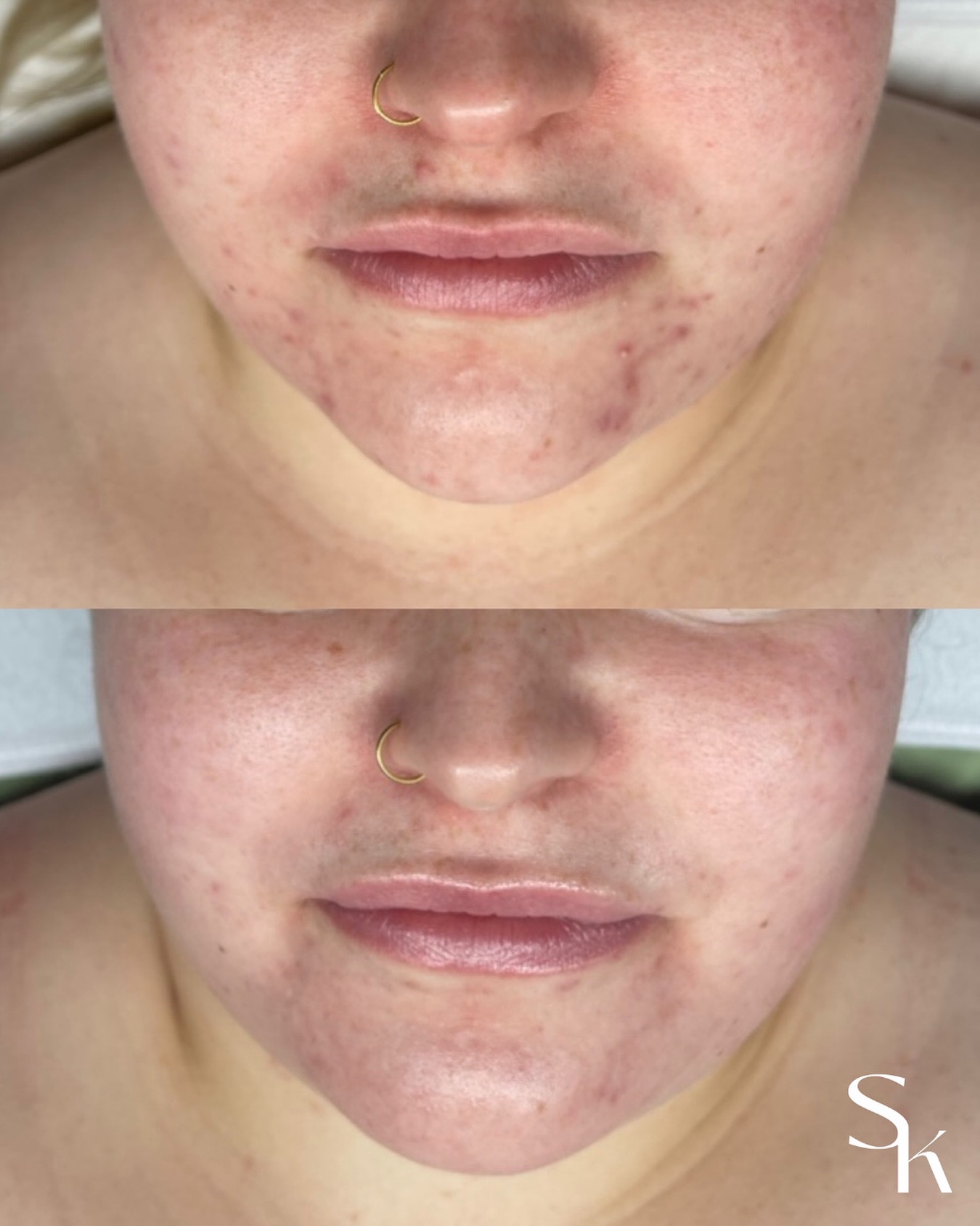 Another day another acne slay ππ»
This is why I cannot get enough of acne transformations... they are so life changing!
If you are ready to start your clear skin journey, book your skin consultation and let's get you glowing! β¨
#spokaneskincare #spokaneacnespecialist #spokaneacnebootcamp #spokaneskinspecialists #spokaneskincareexpert