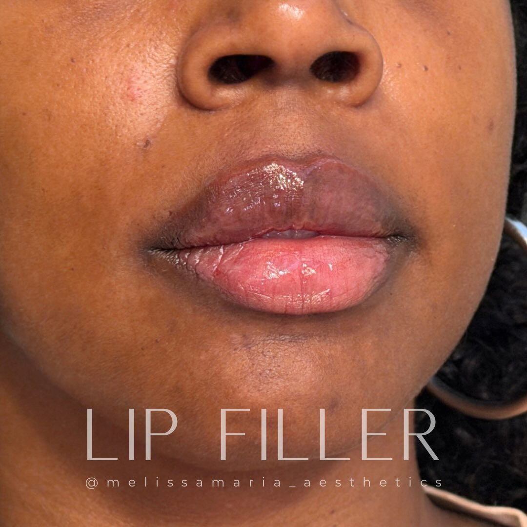 When fuller doesn’t have to look fake! There’s a difference with big and fake. Fake lips are migrated, misshapened, project forward off the face and not harmonious with facial features.