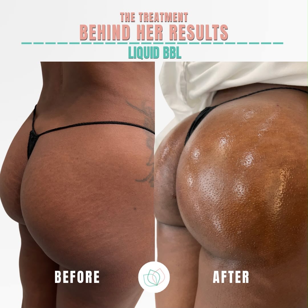 Say goodbye to hip dips and hello to an instant, natural-looking boost with our Liquid BBL procedure. Minimal downtime, maximum confidence, and results that speak for themselves.
Ready to redefine your curves? Send us a DM or tap the link in our bio to schedule your consultation with us today!
📍4600 West Village Place 3005, Smyrna, Georgia
#atlmedspa #liquidbblatl #atlantabbl #atlantaaesthetics #atlglam