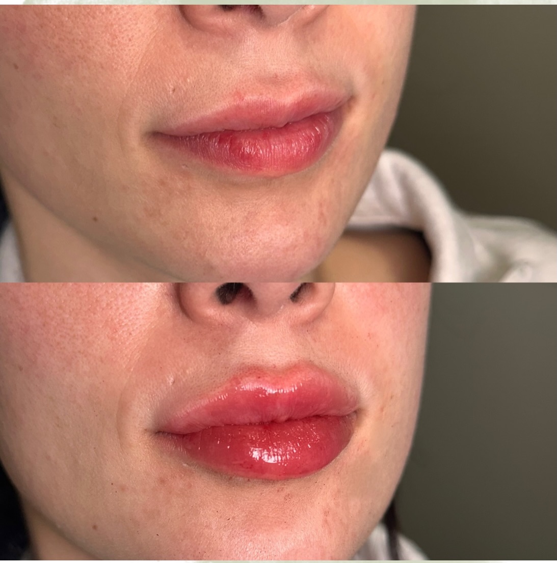 A little enhancement can make a big difference ✨
Natural-looking volume, improved lip balance, and a hydrated, glossy finish, while still looking like you.
💋 Customized lip filler treatment
💋 Soft, natural results
💋 Enhanced shape and definition
💋 Immediate results with continued settling over the next few weeks
Subtle. Balanced. Beautiful.
Book your lip filler consultation today with Nurse Sara!
#lipfiller #lippies #sudburynurseinjector #sudbury #spa