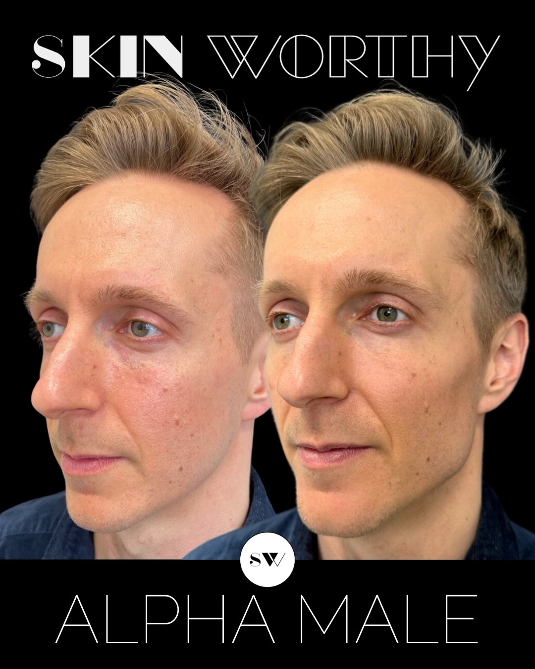 Introducing Alpha Male — a results-driven treatment plan designed for men who want to look sharper, refreshed, and natural.
More men are choosing aesthetic treatments because they’re seeing what’s possible when there’s a thoughtful plan behind the process: elevated results that enhance, not change, their features.
This before and after shows the kind of outcome that can be achieved in as little as 4-6 weeks.
Ready to build your plan? Comment below or send us a DM.