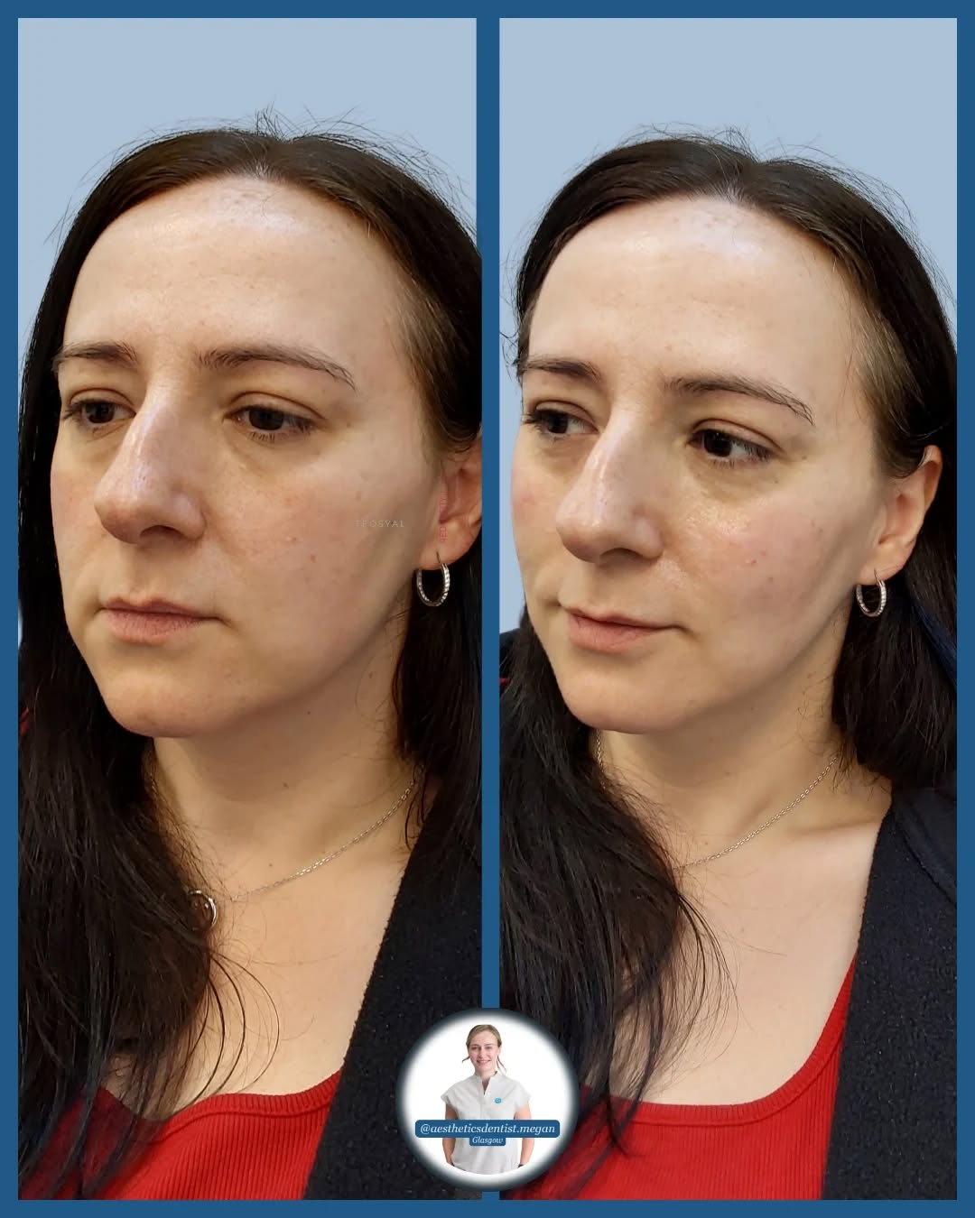 CHEEKS/MIDFACE VOLUME LOSS
For this case, we decided to start with some subtle cheek enhancement.
We were feeling a little tired looking and as though the face had started to drag down and create some lines around the nose (marionettes)
By restoring the apple of the cheek and contouring the lateral aspect/cheekbones we have created a fresher, more rested appearance that will be almost undetectable to the anti-filler crew out there!
Exactly the type of treatment we love @aestheticsdentist.megan : the type of treatment that restores confidence and will compliment the aging process, not completely fight it.
Megan x