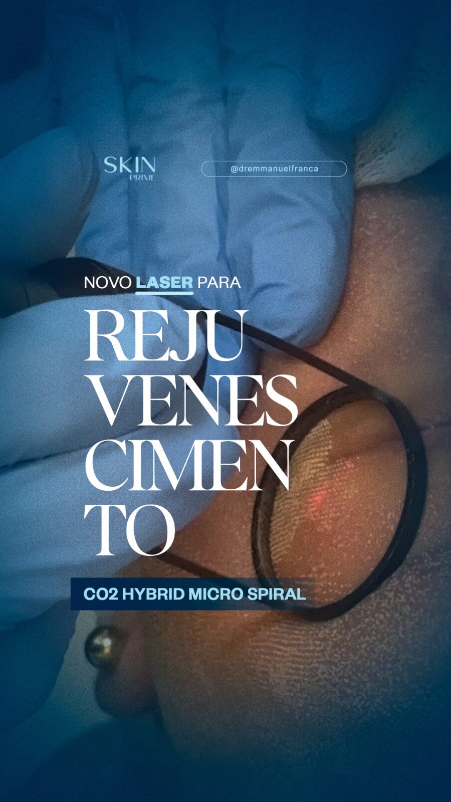 Recebemos na @skinprime_ o novo laser de CO2, o Hybrid, na versão Micro Spiral, da @lmg_oficial. Com certeza, um grande ganho no tratamento dos nossos pacientes!
Dr Emmanuel França
Dermatologista
CRM 5999
RQE 636
📍Skin Prime - Riomar Trade Center - Torre 3 - Sala 1905
☎️ (81) 3036-4040
