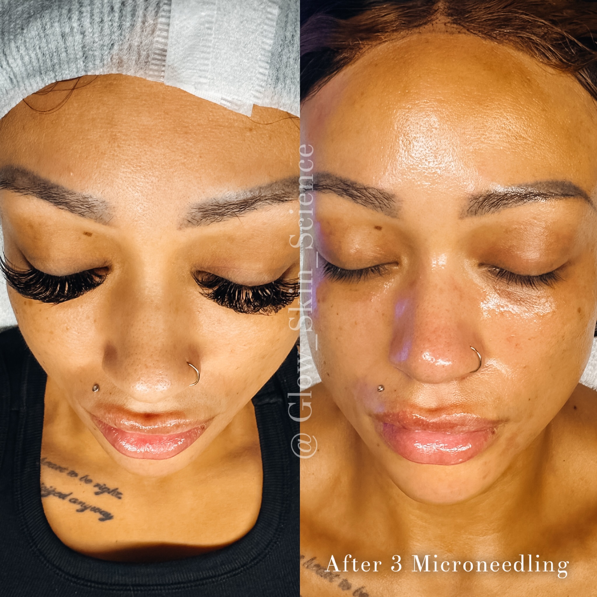 My 2nd favorite part of my job…
(1st is creating magic in the treatment room)…
Getting to meet the most beautiful people inside and out!
I have enjoyed this beautiful woman so much!! Watching her progress, enjoying her company and cheering her on through life’s ups and downs.
Microneedling and medical strength skincare has transformed her skin in the most beautiful way. Dark spots and hyperpigmentation were her biggest concerns.
✨Benefits of Microneedling✨
✅ Reduces fine lines and wrinkles
* Increased collagen can improve skin firmness and soften signs of aging.
✅ Improves acne AND acne scars
* My favorite to reduce the appearance of atrophic (indented) acne scars.
✅ Enhances skin texture and tone
* Can make skin look smoother, rejuvenated, more even, and more radiant.
✅ Minimizes enlarged pores
* While it doesn’t physically shrink pores, firmer skin can make them appear smaller.
✅ With specific techniques and protocols Rosacea is easily reduced and managed.
✅ Reduces hyperpigmentation & Melasma
* Improves dark spots, especially when combined with professional skincare and the addition of appropriate chemical peels.
✅ Reduces stretch marks
* Stimulate collagen in areas affected by stretch marks.
✅ Improves absorption of treatment serums such as PDRN/Exosomes/Stem Cells/Specific Chemical Peels to further boost results and recovery.
* The tiny channels created during treatment temporarily allow certain topical products to penetrate more effectively.
✅ Stimulates hair growth
* Microneedling of the scalp is sometimes used alongside treatments for thinning hair, such as topicals.
👉🏼 What to Expect
* Mild redness and sensitivity for 1–3 days (similar to a sunburn).
* Results develop gradually over weeks as collagen production increases.
* Most people need a series of treatments (often 3–6 sessions) for optimal results.
www.glowskinscience.com
Check out our website for more information.
#microneedling #skinpen #melasma #rfmicroneedling #acnescars