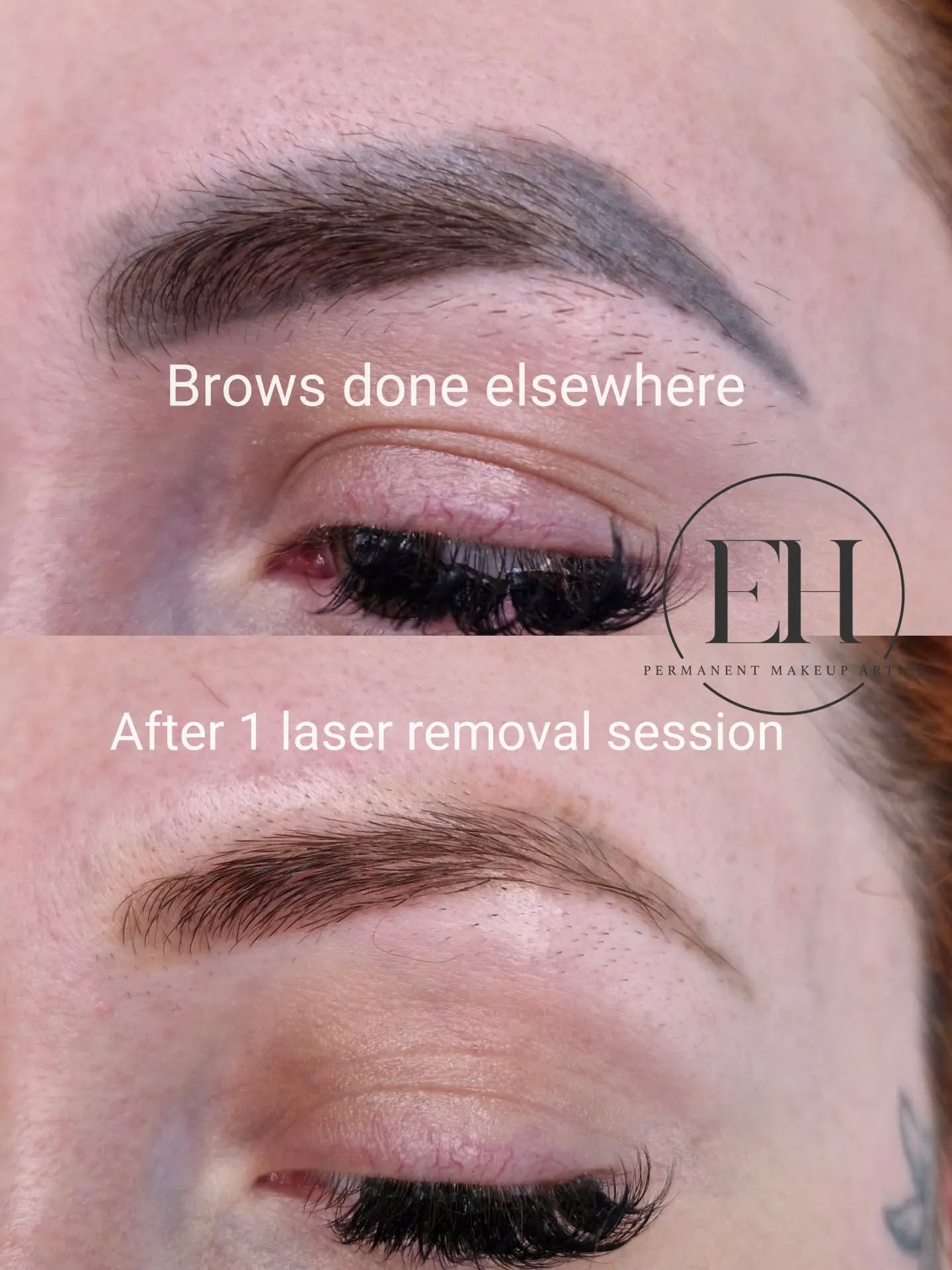 This client came to me with brows that had been tattooed elsewhere.
Over time, the pigment had healed into unwanted grey-blue tones.
She was also unhappy with the shape. The previous artist had created brows that were much thicker and didn't follow her natural brow shape, making them feel less flattering and less like "her".
The photo below shows the result after just one laser removal session. The grey-blue pigment has already faded significantly, and the brows are starting to look softer and more natural.
Laser removal can be a fantastic solution when old permanent makeup has changed colour, migrated outside the natural brow pattern, or simply no longer suits your features. Sometimes the first step to beautiful brows is removing what isn't working.
I'm excited to continue this client's journey and help create brows that complement her natural features beautifully.
#LaserBrowRemoval #EyebrowTattooRemoval #BrowCorrection #tattooremovalstalbans #permanentmakeupremoval