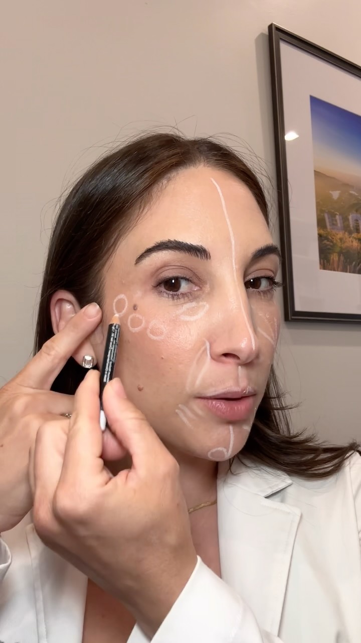 The aesthetics industry has grown so much with advancements in techniques and products over the last 10+ years- it’s pretty amazing to look back and remember the way I was taught to inject versus what has evolved in my practice today.
Over this time we can look back at filler trends, and the logic of how we approach the aging face both highlighting and enhancing our patient’s unique features.
It’s been so fun to grow with the industry!