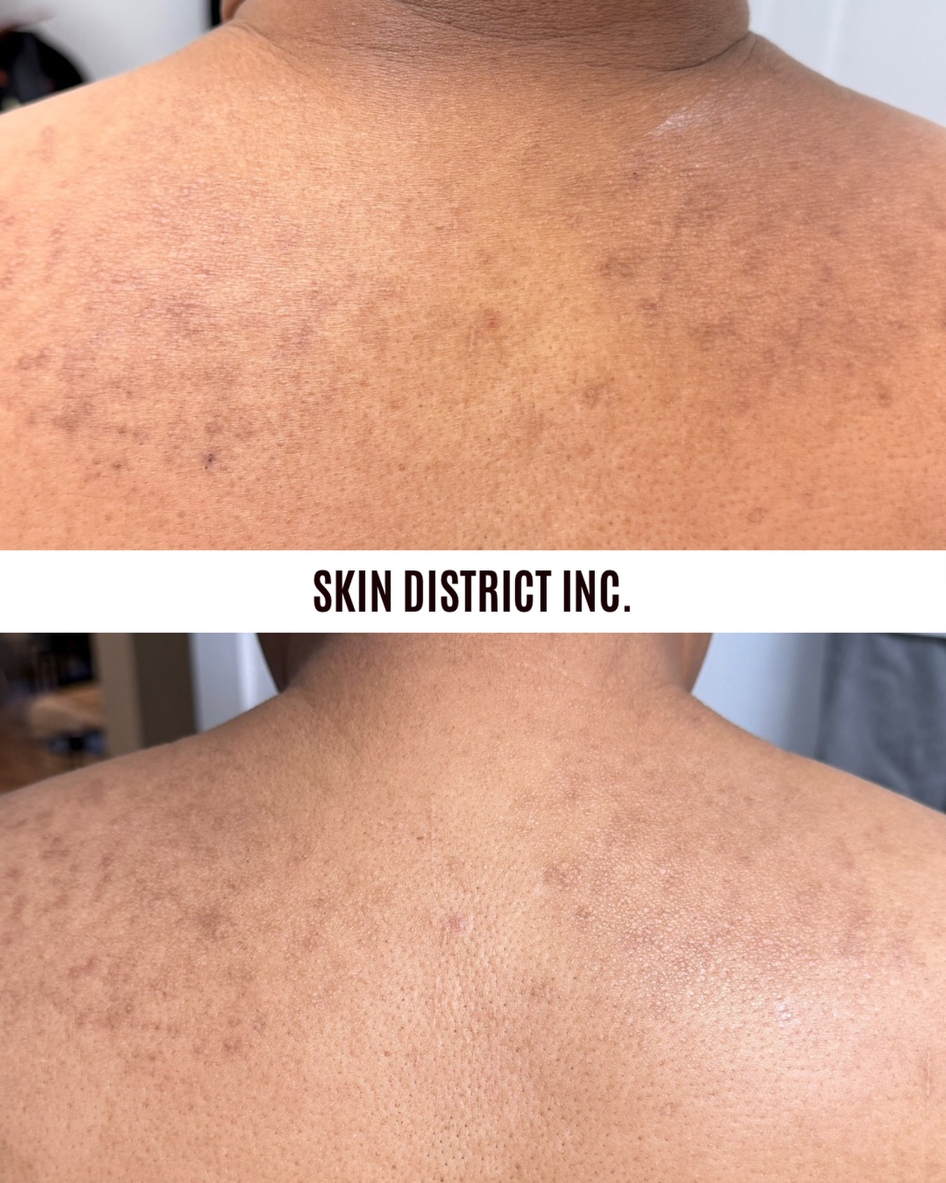 This is your sign to stop picking at your skin and start treating it. đ
These results are after just ONE Nouvaderm session on our clientâs back. We focused on post-inflammatory hyperpigmentation (PIH) left behind from previous breakouts, and the improvement is already incredible.
Nouvaderm works by targeting excess pigment, helping to break up discoloration and stimulate healthy skin renewal for a clearer, more even skin tone.
And weâre not done yet. This client has 2 more sessions planned, and we canât wait to see the final transformation.
If youâve been struggling with acne marks, pigmentation, or uneven skin tone, send me a message to see if Nouvaderm is right for you. â¨