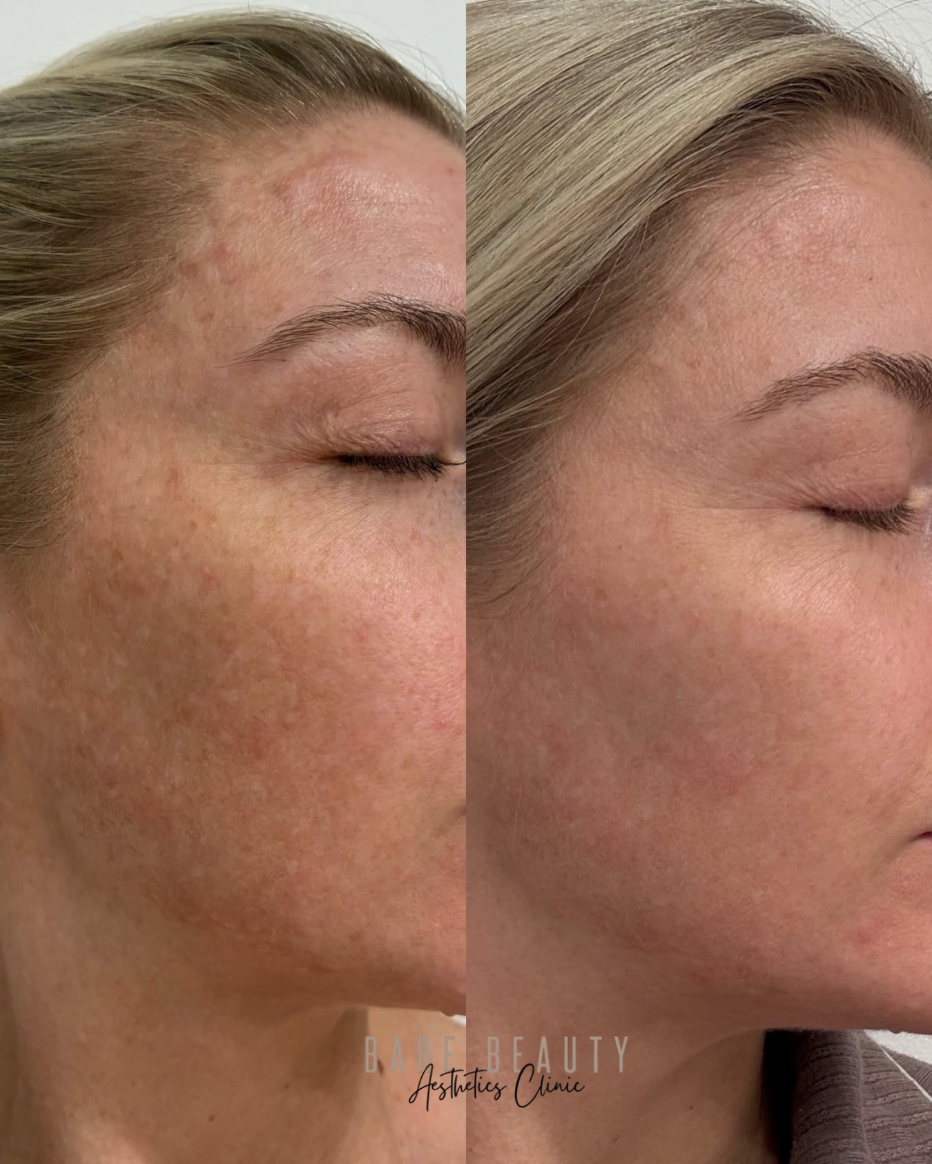 Another benefit to Skin Regenerator treatment.
Melasma is widely considered one of the most challenging forms of pigmentation to treat.
It’s stubborn, complex, and often requires a long-term approach rather than a quick fix.
This result is a great example of what can be achieved with the right treatment plan, combining a course of our skin regenerator with a personalised Aspect DR skincare routine.
Together, they’ve helped improve skin health while dramatically reducing the appearance of stubborn melasma, revealing a brighter, smoother and more even complexion.
Consistency, patience and the right combination of in-clinic treatments and home care can make all the difference.
Individual results vary.
A consultation is required to determine the most appropriate treatment plan.
Images showcased for educational purposes only.
@sunekos_australia @sunekos_official
#bioregenerativemedicine #brisbaneclinic #melasmatreatment #pigment #barebeautybrisbane