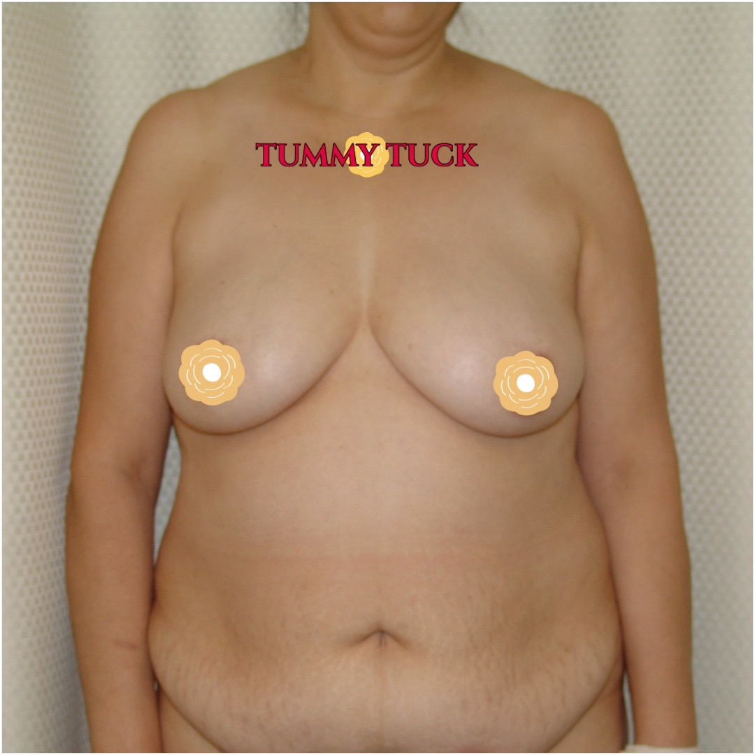 This woman is 50 years old and after her 5 kids had grown up, she was ready to focus on herself. I performed tummy tuck with liposuction of the love handles and rectus muscle tightening. She now loves her new tummy. Call now for our Independence Day 250th Specials! Saline Breast Aug -->$3995 Silicone Breast Aug --> $6495 Tummy Tuck starts at --> $7995. Call (714) 500-0050 #drluudoan #breastaug #salineimplants #siliconegelimplants #tummytuck #abdominoplasty