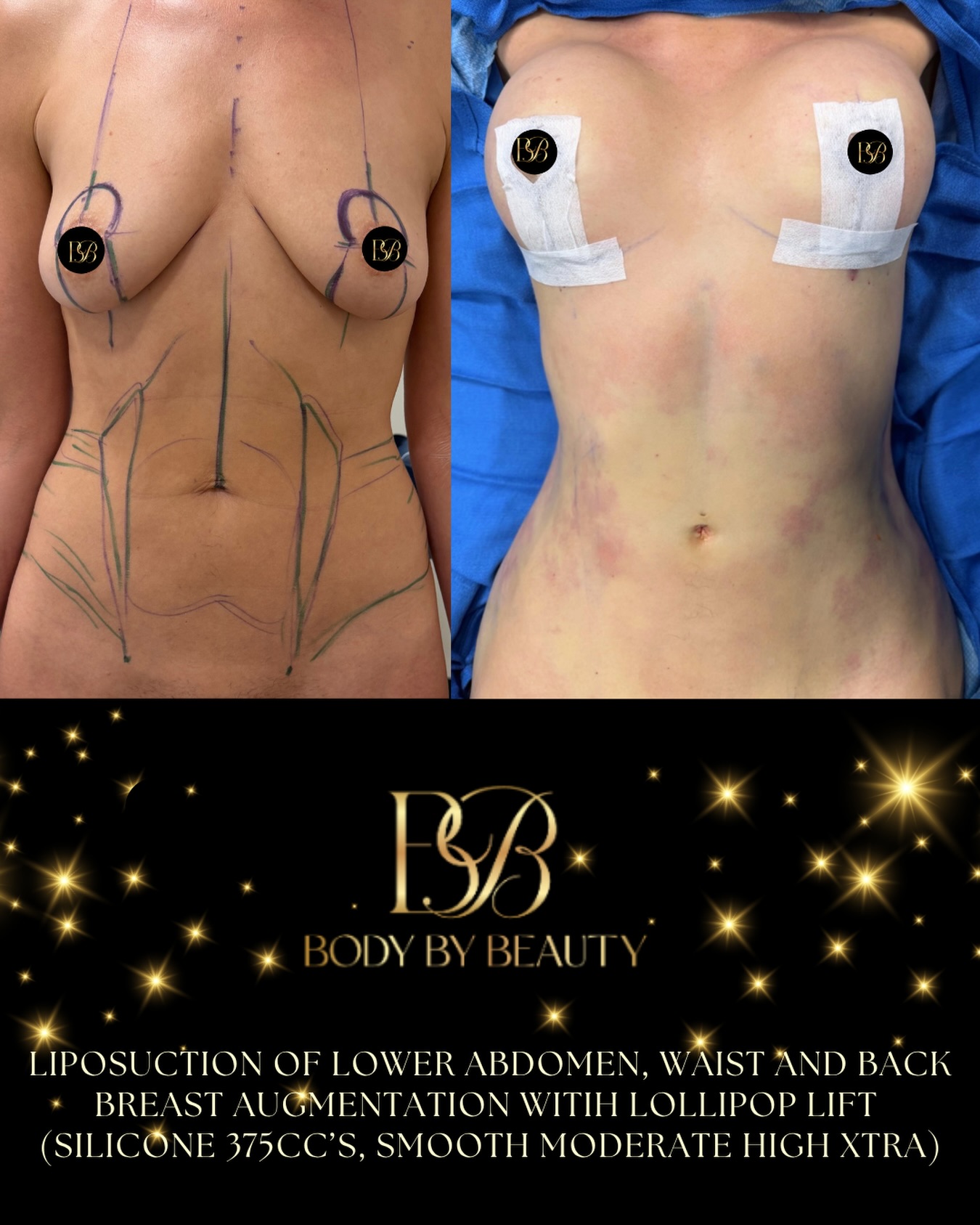 From Canada to Florida, just in time for summer.☀️
Your dream results do not have to be limited by where you live. Ready to be Summer ready?
Call us at 386-DrTower or visit us at www.BodybyBeauty.com to self-schedule your consultation today! 💕
#bodybybeauty #travelsurgery #thesurgicalinstituteofcentralflorida