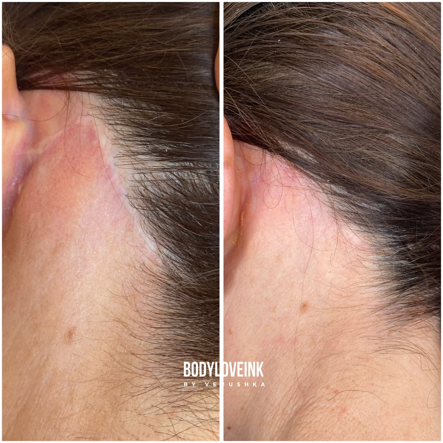 Face lift scar = undetectable - results of consistency and patience✨
#facelift #faceliftscar #deepplanefacelift #cosmeticsurgery #Bodyloveink