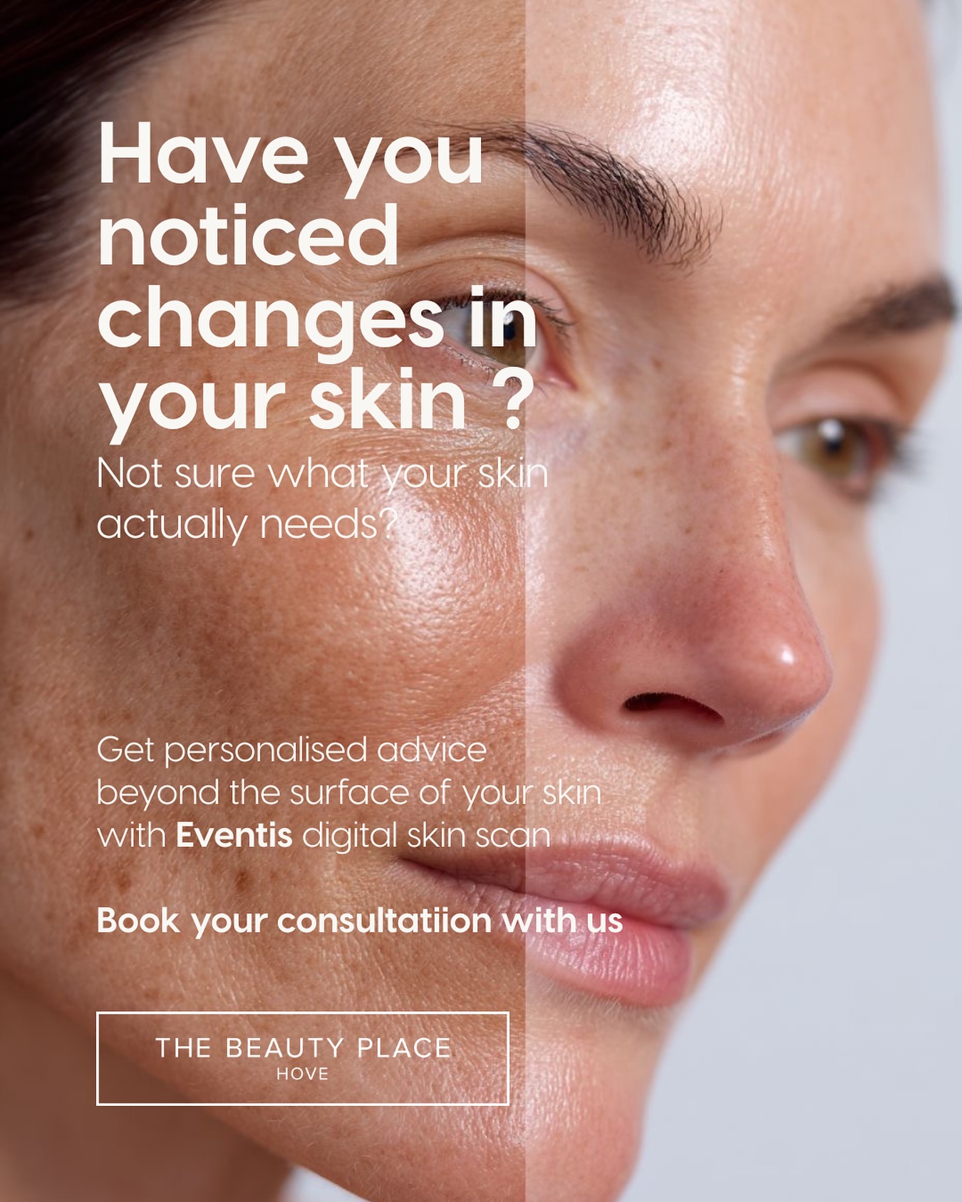 Have you ever looked at your skin and wondered whether you’re actually using the right products?
Many people invest in skincare without truly understanding what their skin needs. Concerns such as dehydration, sensitivity, redness, pigmentation and premature ageing can often develop beneath the surface long before they become visible.
Our Eventis Skin Health Consultation combines advanced imaging technology with professional skin analysis to give a deeper understanding of your skin. Using natural, redness and UV imaging, alongside advanced hydration and skin barrier assessment, we can identify concerns that may not yet be visible to the naked eye.
The consultation goes beyond a standard skincare assessment. We look at your skin, lifestyle, current routine and long-term goals to create a personalised treatment and homecare plan designed specifically for you. Eventis also allows us to track your skin over time, so you can see measurable progress throughout your skin health journey.
Healthy skin is rarely achieved through guesswork. The best results come from understanding your skin properly and making informed decisions based on expert advice and real data.
Have you ever had your skin professionally analysed? Let us know in the comments below.
To begin your skin health journey, book your Eventis Skin Health Consultation with our expert team.
#skinhealth #skin #eventis #finelines #wrinkles #dehydratedskin #thebeautyplacehove #consultation #skingoals #skintreatment
