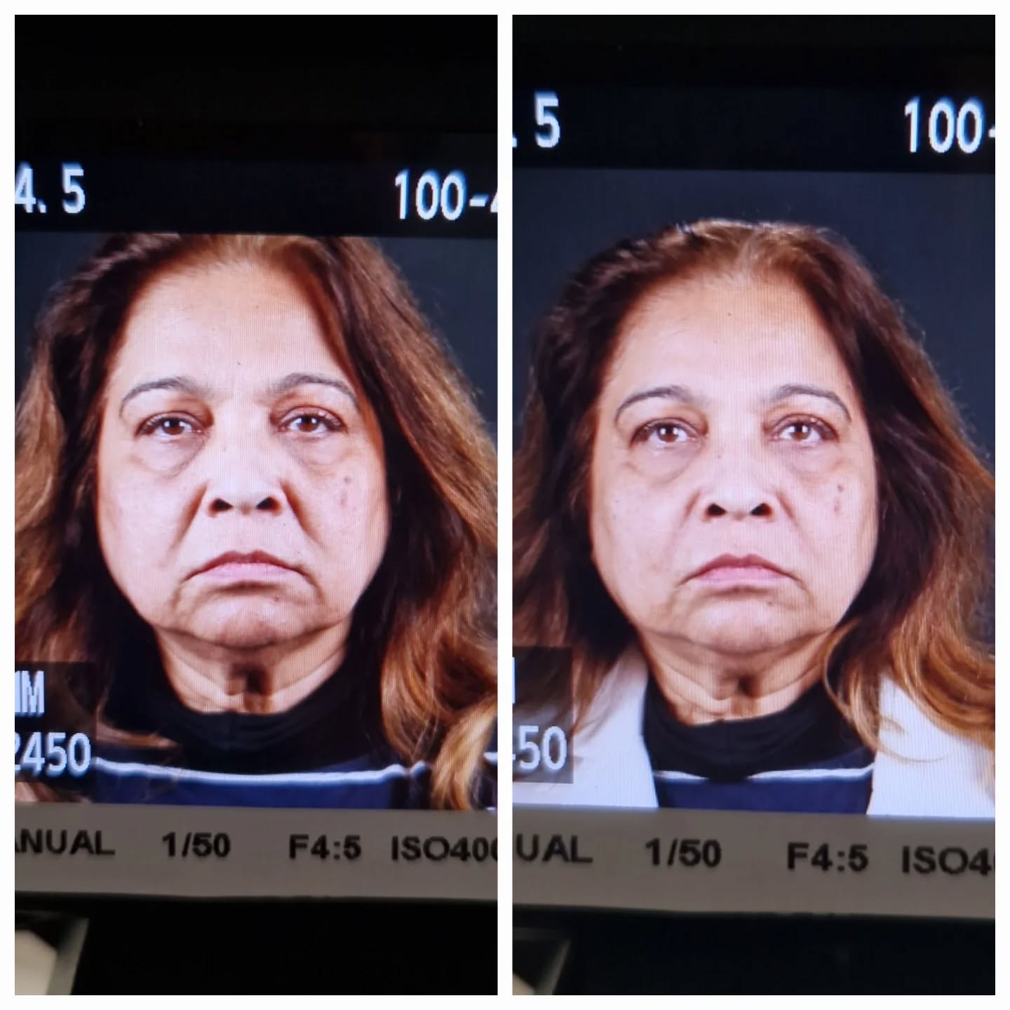 Why does the face start to "drop" as we age?
It is not just the skin.
As we get older, we gradually lose collagen, elastin, fat, muscle support and even bone volume. The structures that once held the face up become weaker, while gravity continues to pull everything down.
This can lead to:
• Heavier jowls
• Deeper nasolabial folds (nose to mouth lines)
• Marionette lines
• Loss of cheek definition
• Sagging around the jawline and neck
• A tired or sad appearance
The good news is that we do not always need surgery to improve this.
Modern aesthetic treatments can help restore support and stimulate your body's own collagen production, creating a subtle lift and improving facial structure over time.
Depending on your concerns, treatments may include:
• Sculptra/AesPlla to rebuild collagen
• Dermal fillers to restore lost volume and support
• Polynucleotides to improve skin quality
• Skin tightening treatments to improve laxity
The key is not to "fill" the face, but to restore what has been lost and support the face in the right places for a natural, refreshed appearance.
Ageing is inevitable. Looking tired doesn't have to be.
Book a consultation to discuss the best options for you.