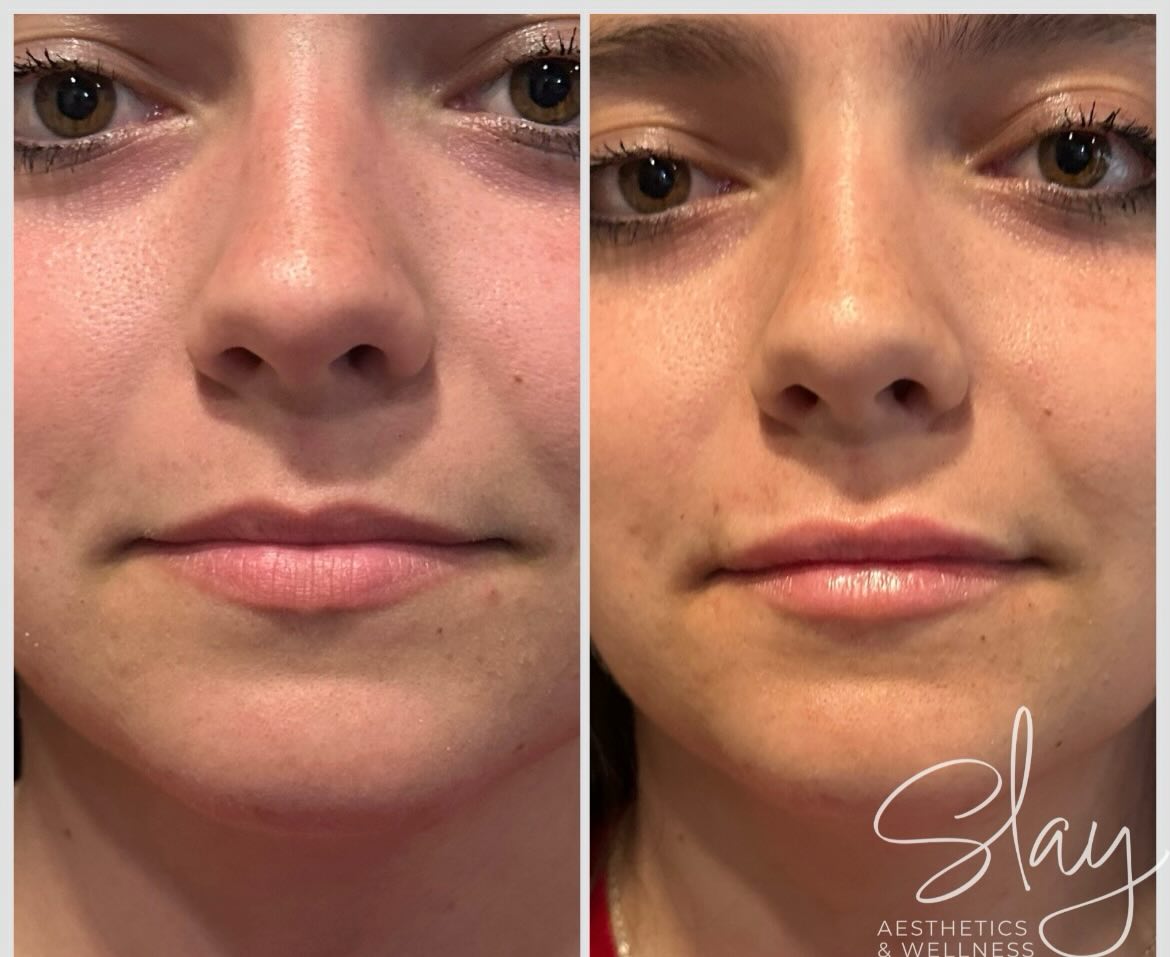 💋 A little filler can make a beautiful difference.
Natural-looking volume, enhanced shape, and balanced symmetry—without losing what makes your lips uniquely yours.
Ready for your own glow-up? Let’s create lips you’ll love while keeping results soft, refreshed, and natural.
✨ Lip Filler by Nurse Practitioner Shannon Francis
📅 Book Now:
https://slay-aesthetics.janeapp.com/
🌐 Website:
https://slay-aesthetics.com
💳 Financing Available:
https://www.slay-aesthetics.com/payment-plans
#LipFiller #LipEnhancement #NaturalLipFiller #AestheticInjector #nursepractitioner