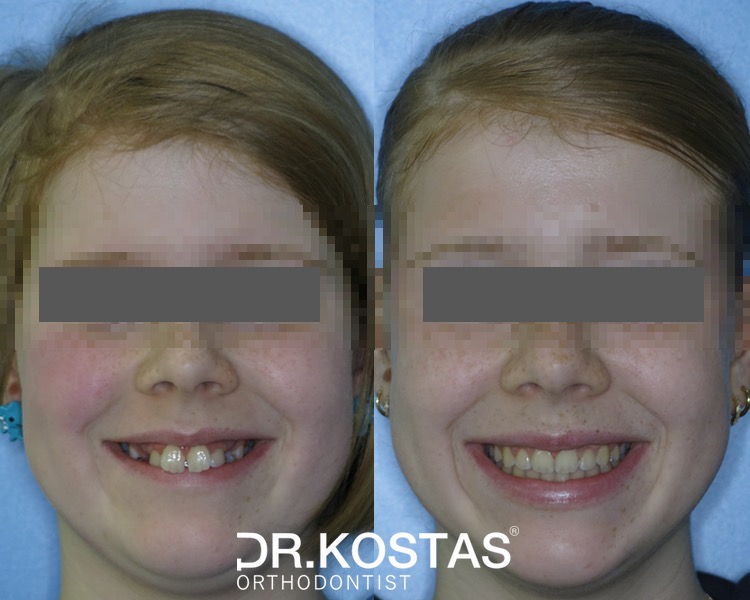 This teenage patient was treated without extractions and finished in 22 months. Her treatment involved arch expansion and space opening for both unerupted upper canines. The results were rewarding as always. Contact us today to schedule your child's initial orthodontic assessment and get you started 😊
#drkostas #kidsorthodontics #specialistorthodontist #kidsbraces #dublinbraces #smile #smiletransformation #dublinorthodontist #smilemakeover #dublin #orthodontics #straightteeth #teethstraightening #damonbraces #smiletransformation
