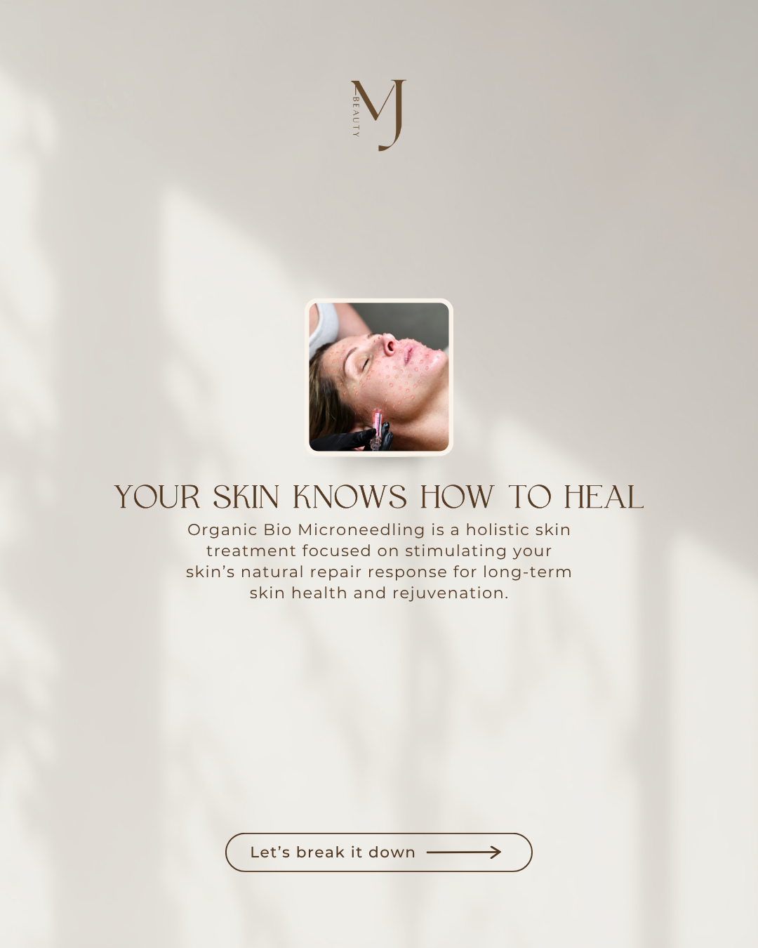 Organic Bio Microneedling is designed to stimulate the skin naturally from within â¨â
â
This advanced treatment works to support collagen production, improve skin texture, refine pores and restore overall skin vitality all while focusing on long-term skin health, not quick fixes.â
â
The result? Stronger, healthier more radiant skin over time.â
â
Click the link in our bio to book your appointment đ