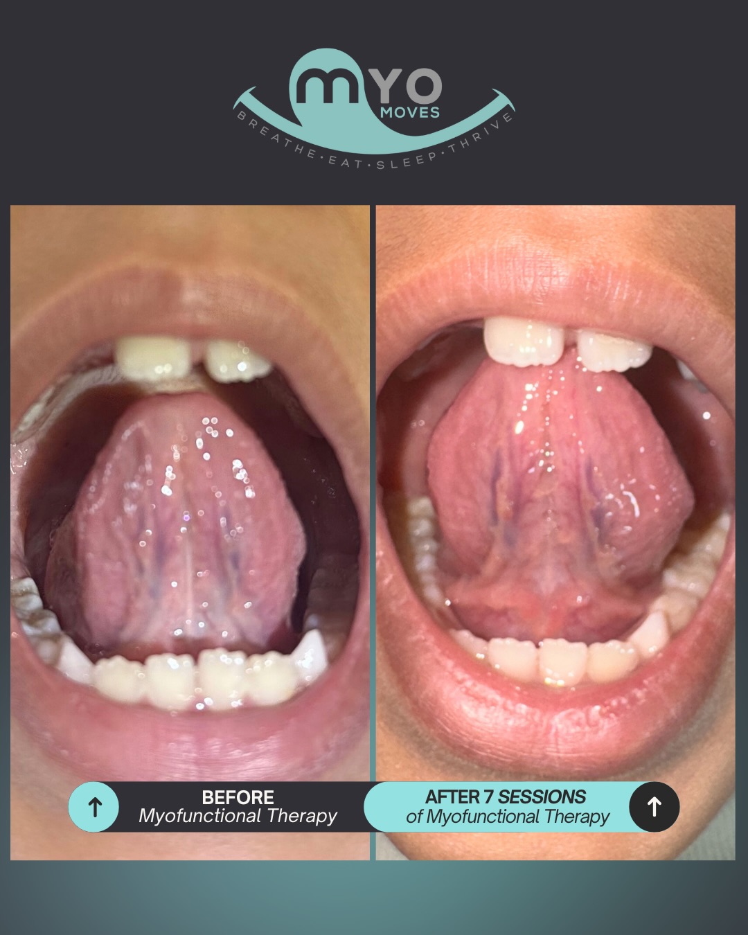 This is what improved function looks like in real life. When the tongue learns to rest where it belongs, the lips close naturally, the jaw relaxes, and the airway opens up. The whole face changes, because the whole system is finally working together.
What her parents noticed:
✔️ Less snoring
✔️ Less clenching & grinding
✔️ Consistent nasal breathing
Better breathing means better sleep. Better sleep means better everything.
If you’ve been wondering whether myofunctional therapy could help your child, this is your sign.
💬 Comment GUIDANCE and we’ll send you the details.
#MyofunctionalTherapy #AirwayHealth #NasalBreathing #BeforeAndAfter #breathebetter