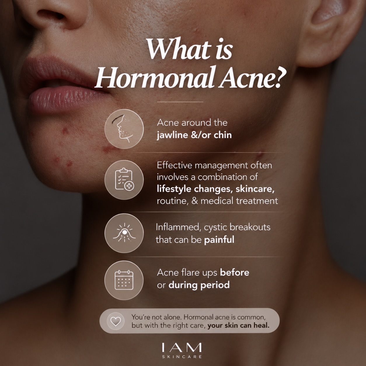 ✨ Hormonal acne isn’t just a skincare issue—it’s often a sign that something deeper is happening beneath the surface. Hormonal fluctuations can trigger painful, stubborn breakouts along the chin, jawline, and lower face that don’t always respond to over-the-counter products.
At IAM, we take a comprehensive approach to acne treatment because no two acne journeys are the same. Your customized treatment plan may include:
✔️ Medical-grade facials and acne-focused treatments
✔️ Personalized skincare programs tailored to your skin type and goals
✔️ Blue light therapy to target acne-causing bacteria
✔️ Laser treatments to reduce inflammation, redness, and acne scarring
✔️ Microneedling to improve acne scars and skin texture
✔️ Prescription tretinoin for cellular turnover and prevention
✔️ Spironolactone for hormonal acne management
✔️ Oral contraceptives when appropriate for hormonal regulation
✔️ Low-dose Accutane programs for persistent or severe acne
Our licensed providers and clinical aestheticians work together to create a treatment plan that addresses both the symptoms and the underlying causes of acne.
💙 Clear skin is possible—and you don’t have to figure it out alone.
📍 Institute of Aesthetic Medicine Berlin, MD Milton, DE
📞 Schedule your acne consultation today and let us create your customized path to healthier, clearer skin.
#IAMSkinLab #HormonalAcne #AcneAwarenessMonth #AcneTreatment #ClearSkinJourney MedicalAesthetics BlueLightTherapy Microneedling Tretinoin Spironolactone Accutane MedicalGradeSkincare BerlinMD MiltonDE InstituteOfAestheticMedicine HealthySkinStartsHere