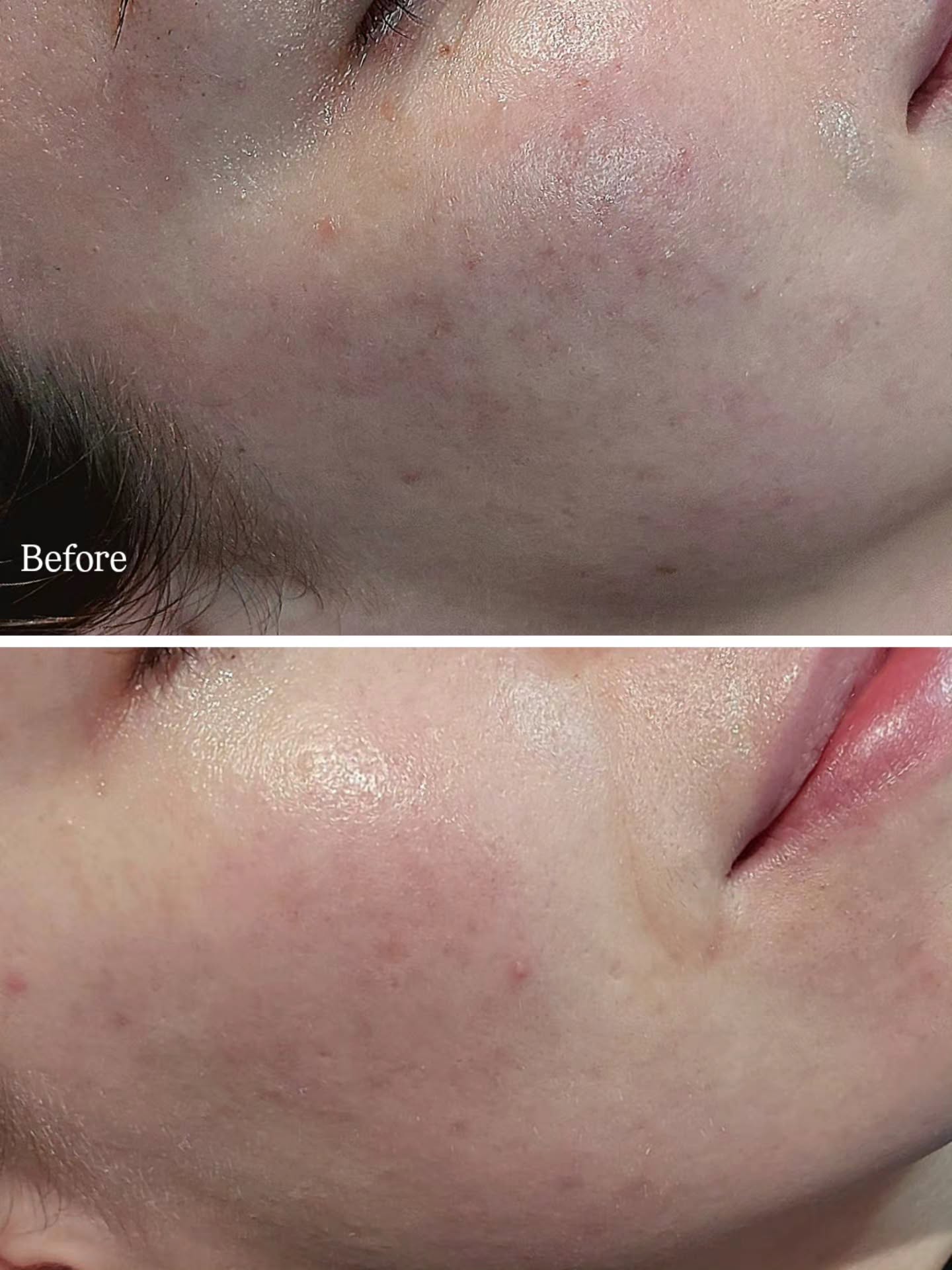 > Upper image shows active breakouts & texture issues.
>The lower image demonstrates reduced redness and improved skin texture.
The treatments we used, involve stimulating the skin's natural healing process and skin resurfacing sessions.
She is absolutely amazed by the results so far and cant wait to book for more sessions 👌🏼
#mostpopular #foryou #bestlife #antiwrinkletreatment #SkincareBenefits