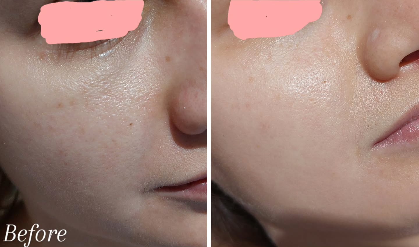 Its hard to see the difference in photos sometimes, but this client wanted to achieve a healthy glow, reducing the dullness and improving the texture. Can you spot it?
One session can be enough, but but booking in for regular sessions will help to improve longevity of healthy looking skin as it takes time to re-build collagen and improve the skin barrier over time.
Book for a face to face consultation online if you have a skin concern. We will point you in the right direction.
Katsbeauty3.booksy.com