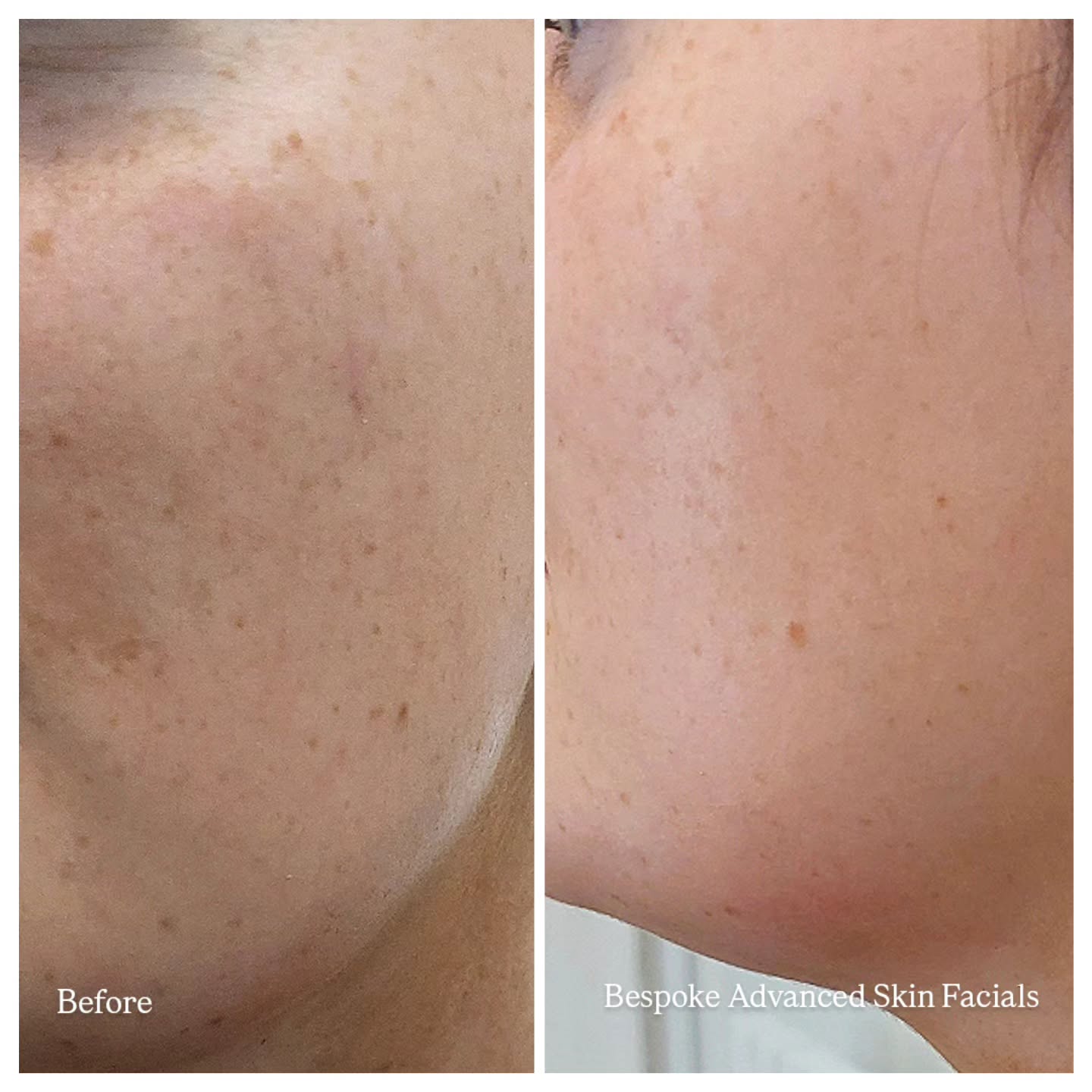 A close-up comparison of my clients' cheek and jaw area.
>The left panel demonstrates patchy, light brown pigmentation scattered across the skin surface.
>The right panel demonstrates a noticeably clearer, brighter, and more uniform skin tone, which appears to show the successful fading or clearing of localized pigment.
Tailored treatment packages to suit your needs will lead to a more successful outcome 🌟. Book Online for your consultation to find out more. Katsbeauty3.booksy.com #bristol #bristolaesthetics #SkincareJourney #skincaregoals #bristolfacials