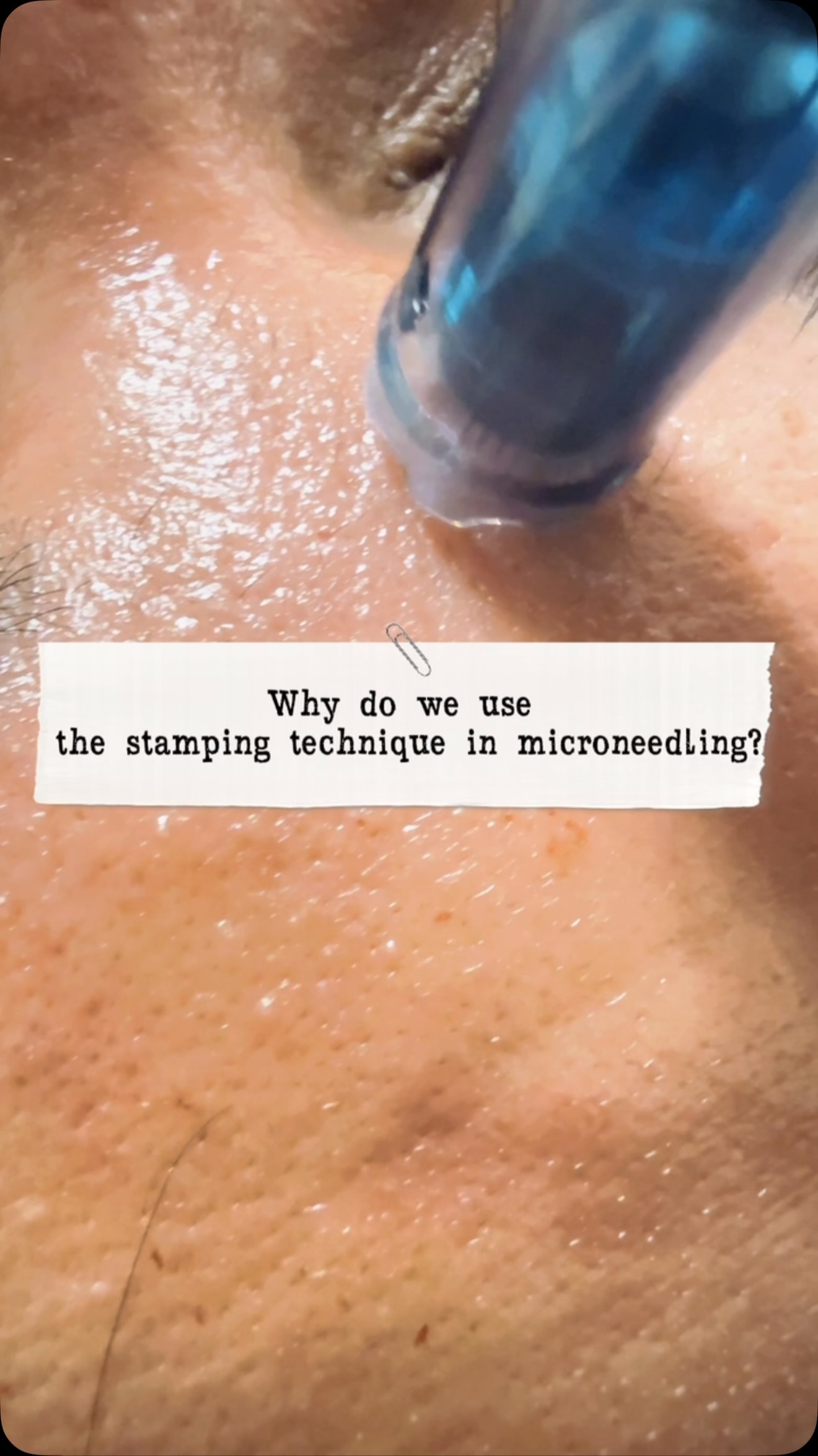 One reason I prefer the stamping technique for microneedling is precision. Instead of dragging across the skin, the needles stamp vertically, creating clean micro-channels with less trauma. This allows for better collagen stimulation, improved scar treatment, and enhanced absorption of regenerative serums like exosomes for optimal results.
#surrey #hauteesthetics #delta #glowingskin #canada