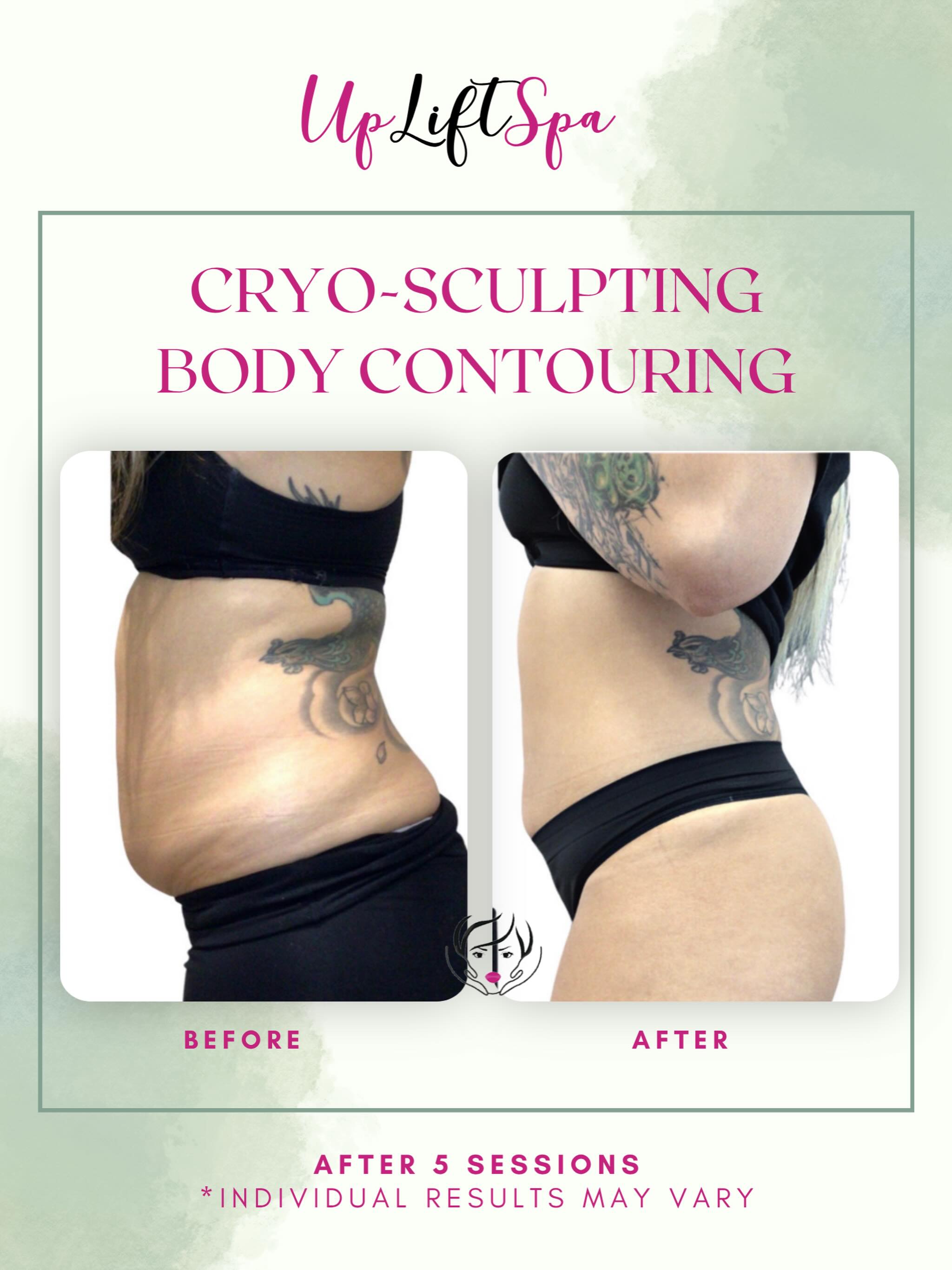 Snatched without the surgery ✨
Cryosculpting for the abdomen targets stubborn fat, helping reduce volume and improve contour over time.
Think: a more defined waist, smoother silhouette, and visible results with consistency.
Because sometimes, diet and workouts need a little extra help.
📲 Ready to start your transformation? DM me “CRYO” and let’s build your plan.
#CryoSculpting #AbdomenContouring #BodyGoalsNYC #medspanyc