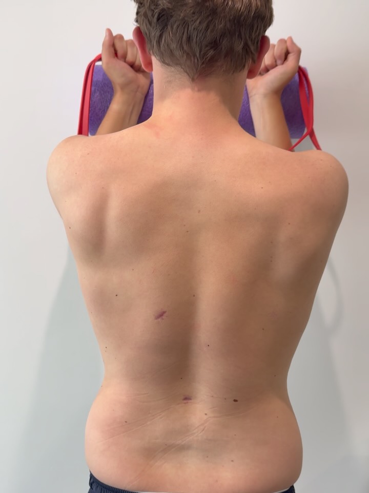 PRE ➡️ POST
Following a full assessment of the shoulder, neck and shoulder blade mechanics, we identified a number of movement control deficits contributing to this patient’s symptoms.
The patient was experiencing shoulder pain with referral into the latissimus region and down the arm. Testing revealed reduced shoulder blade control and stability during overhead movement.
After the initial treatment session, we can already see improvements in shoulder blade movement and tracking during the same exercise.
Treatment included:
✔️ Movement retraining
✔️ Scapular stability exercises
✔️ Shoulder strengthening
✔️ Hands-on treatment
This doesn’t mean the problem is resolved after one session, but it demonstrates how quickly movement patterns can change when the right deficits are identified and addressed.
Rehabilitation is rarely a one-off fix. Most long-term results come from progressively developing strength, control, movement quality and load tolerance over time.
The next stage of rehabilitation will focus on progressing shoulder strength, scapular control and load tolerance to help these improvements become more consistent and long-lasting.
#ShoulderRehab
#ShoulderPain
#ScapularControl
#Physiotherapy
#SportsMassage