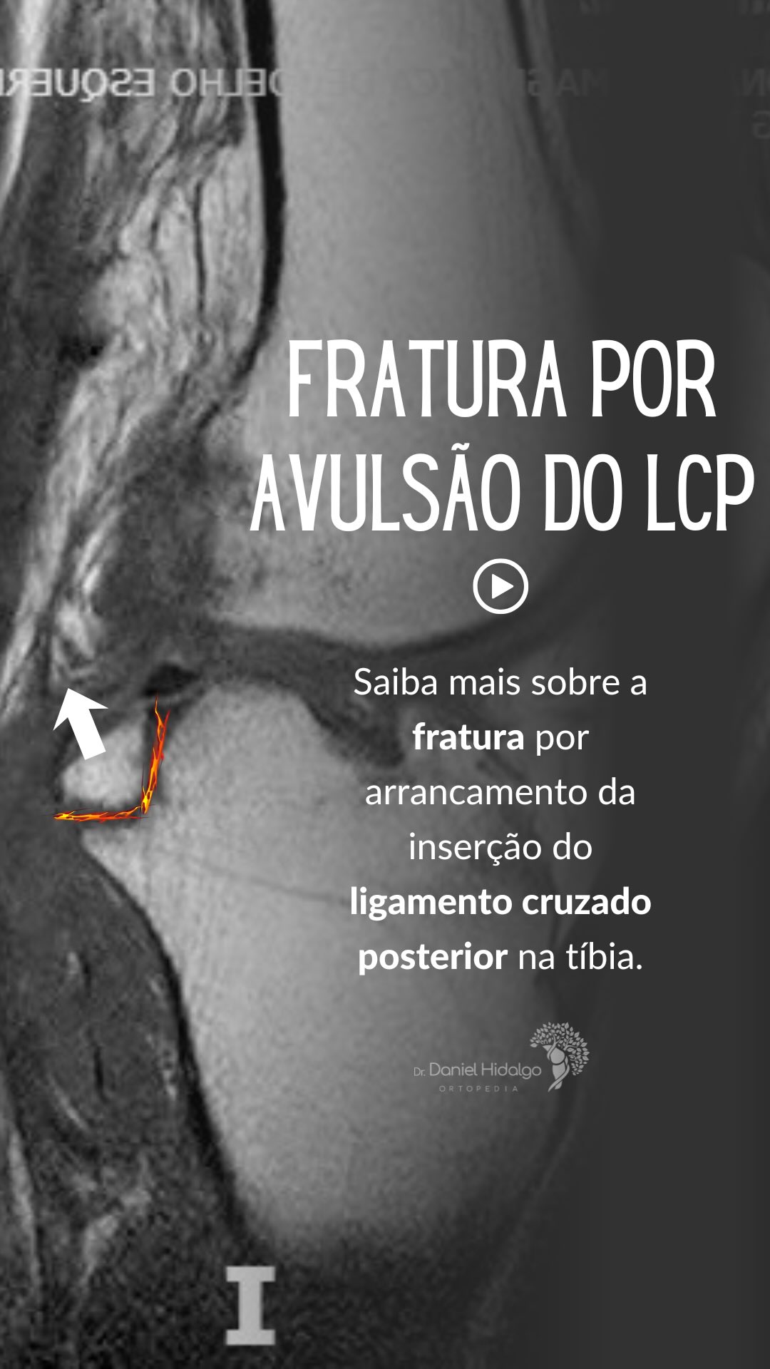 Neste vídeo apresento um caso de fratura por arrancamento da inserção tibial do #LCP, também conhecida como fratura-avulsão. Esta lesão é relativamente incomum, mas pode comprometer significativamente a estabilidade do joelho quando não diagnosticada e tratada adequadamente. #joelho #ortopedia