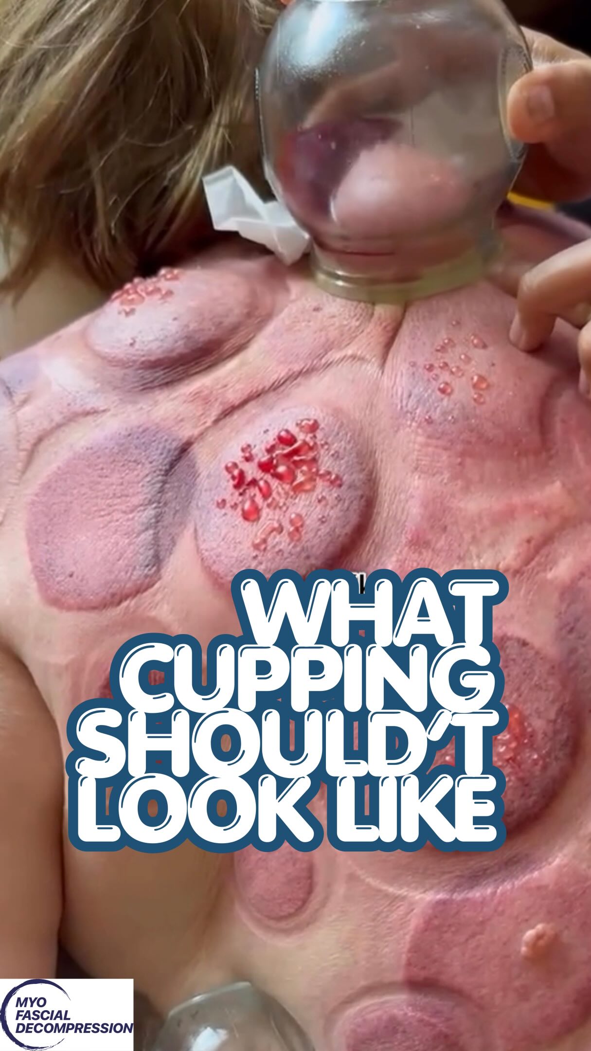 Everyone gets this last part wrong… That ‘jelly’ you see scraping off post-cupping isn’t toxins escaping the body. It’s not a super detox. It’s not your fascia releasing trauma. It’s superficial coagulated blood and serous fluid from a vacuum pulling on tissue you’ve broken the skin barrier on. Don’t try it on toast either, a bit on the bitter salty side😅🍞
⭕️
And blisters aren’t an indication that you are pulling out the wet stuff from the body. They’re a sign the dosage and intensity was wrong.
⭕️
The internet loves the toxin narrative because it’s a satisfying visual story: dark, thick fluid = bad stuff leaving the body. But your liver and kidneys are already handling detoxification, 24/7, without a glass cup’s help.
Know your pressure, your rationale, and a frequency/dosage that’s actually supported by data, not tradition alone. Level up. Follow for the real science of modern cupping and recovery.
#whatthecupwednesday #wetcupping #hijama #cuppingmarks