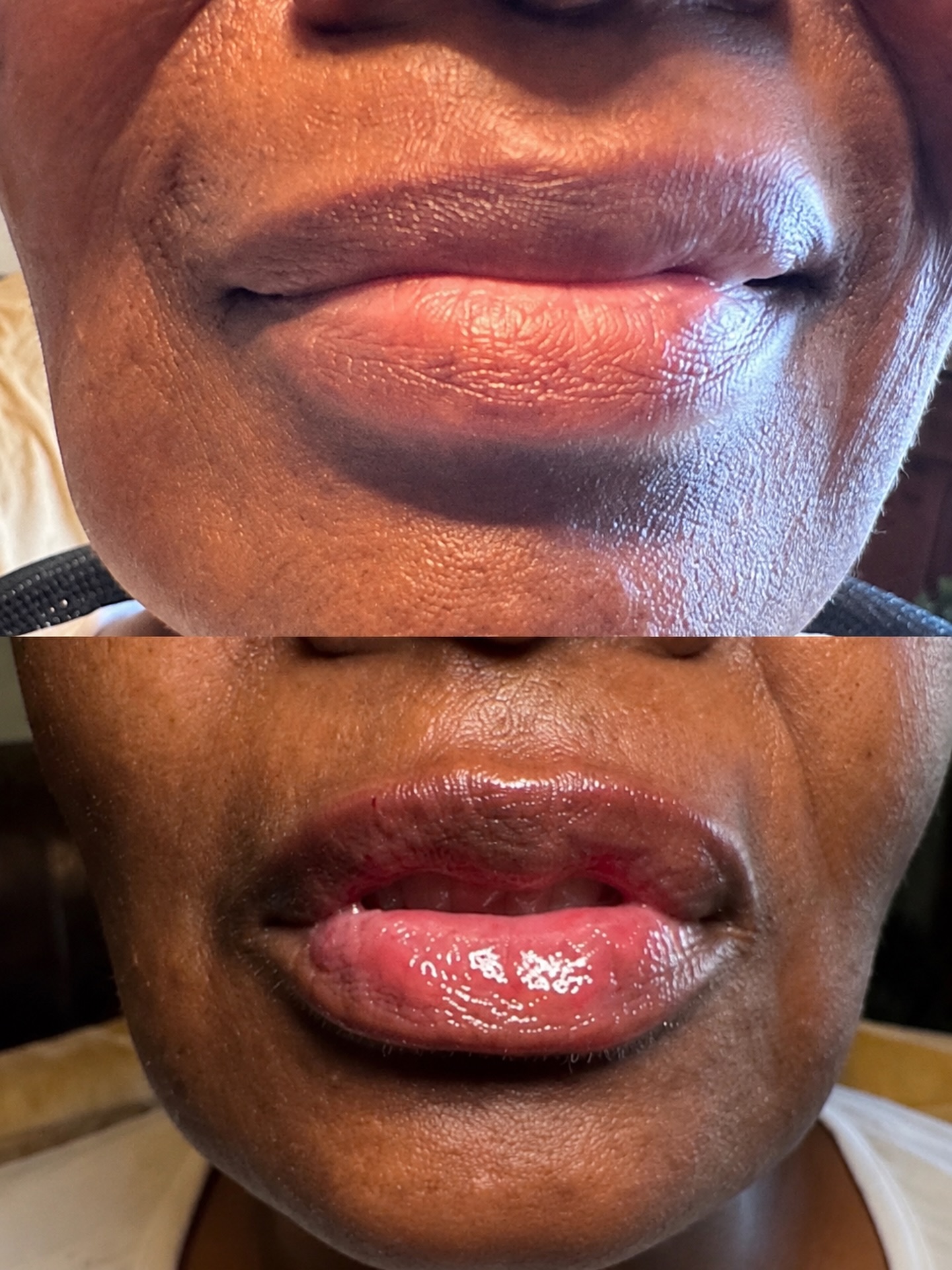 💋 The best lip filler doesn’t look overdone. it simply looks like you.
Beautiful lip filler is all about balance, symmetry, and enhancing your natural features. This transformation added subtle volume while maintaining a soft, natural-looking result that’s customized to the client’s unique lips.
Thinking about lip filler but want a natural, refreshed look? I’d love to create a treatment plan that’s tailored just for you. Schedule your consultation today! ✨
#lewisvilletx #lewisvillemedspa #lipfillerlewisvilletx #dfwaesthetics #naturallipfiller
