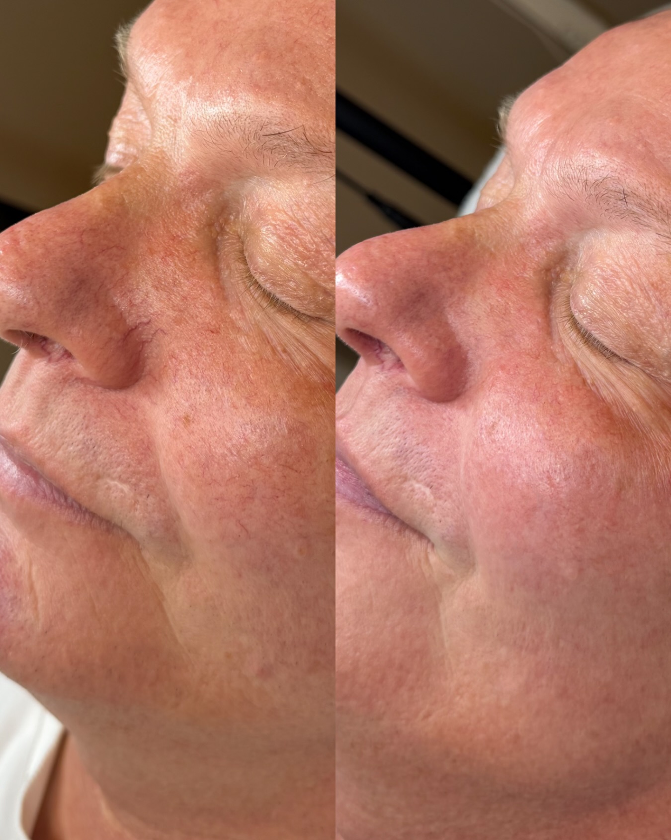 illumiFacial results from 3 sessions ⚡️
My client came to me suffering with quite vascular skin, with several thread veins and moderate signs of skin aging. We did a course of 3 illumiFacials to really help tackle those concerns whilst brightening and rejuvenating the skin
People often ask me WHY I chose to go with a Lynton Device and the answer is simple, the science and safety behind it! As an NHS recognised device, we are able to deliver intense and effective results without causing excessive heat - meaning less downtime for you as the client!
IPL can can also treat the following skin concerns;
Redness
Rosacea Symptons
Hyperpigmentation & Sun Damage
Anti-Aging Concerns
Skin Rejuvanation
@lynton_uk
#lyntonipl #skincareresults #threadveinremoval #skinclinicaltrincham #iplcheshire