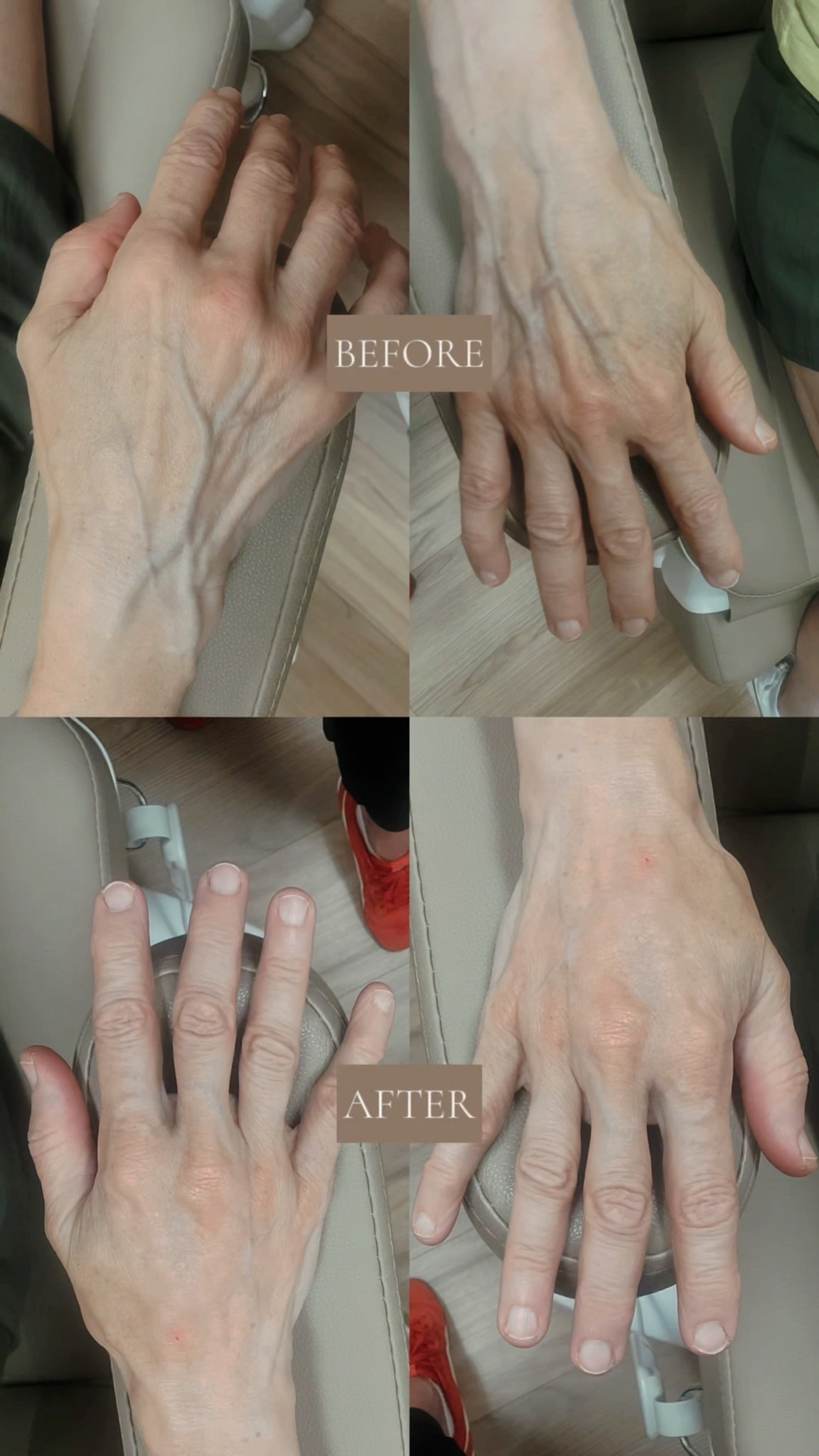 Your face isnât the only place that shows signs of aging, your hands often tell the story first.
Over time, we naturally lose collagen, which can lead to volume loss, thinning skin, and that crepey texture many people notice on the backs of their hands.
One of our favorite ways to address this is with hyperdilute Radiesse. Unlike traditional filler, it works as a biostimulator, encouraging your bodyâs natural collagen production to gradually improve skin quality, firmness, and texture over time.
This before + after shows the results after just one treatment.
If your hands have started to look older than you feel, this treatment may be worth adding to your rejuvenation plan.
Ready to learn if hyperdilute Radiesse is right for you?
Schedule a consultation with our team, weâd love to create a personalized treatment plan for your goals.
www.skinnovationswisconsin.com
#Radiesse #Collagen #Skinnovations #Wausau #Minocqua #NursePractitioner #MedicalAesthetics